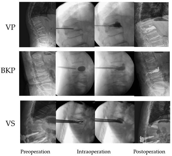 Treating Compression Fracture with Kyphoplasty vs. Bracing