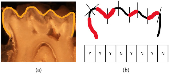 Mean scores for dental caries in the mandibu- lar molars of each group.