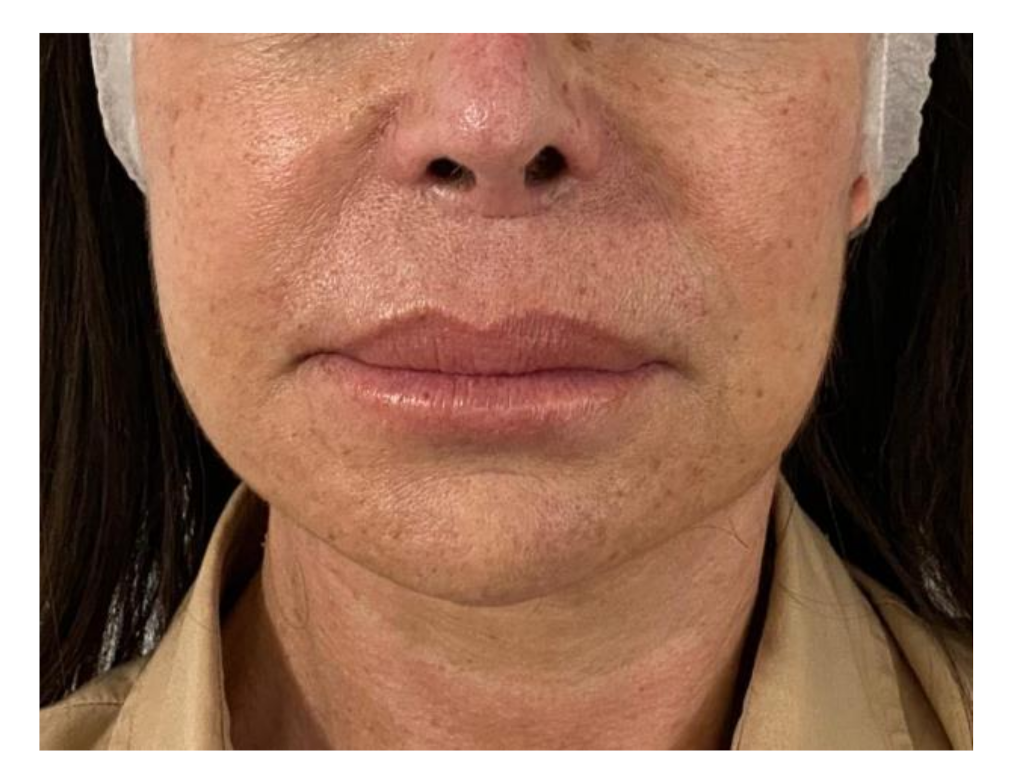 Applied Sciences | Free Full-Text | Non-Surgical Touch-Up with Hyaluronic  Acid Fillers Following Facial Reconstructive Surgery