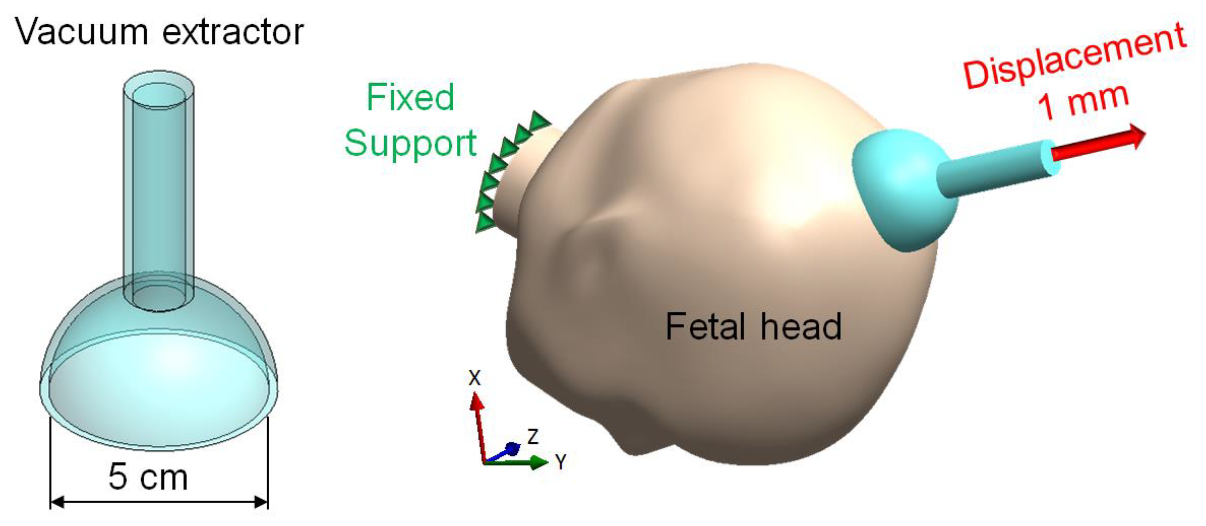 Applied Sciences | Free Full-Text | Investigating the Vacuum Extractors of  Biomedical Devices of Different Materials and Pressures on the Fetal Head  during Delivery