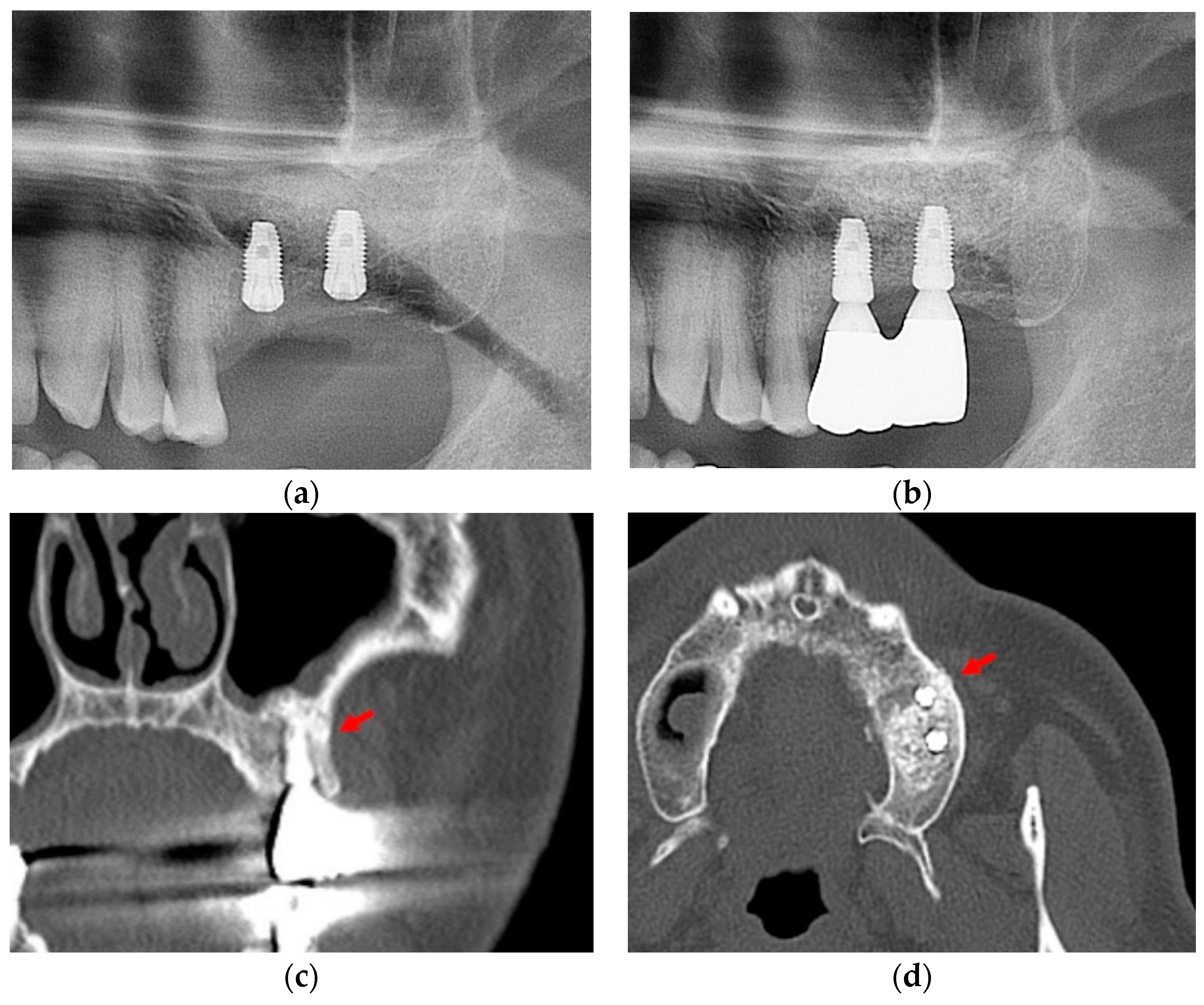 Procedure for the transalveolar approach. (A) OAF. (B) Separate the