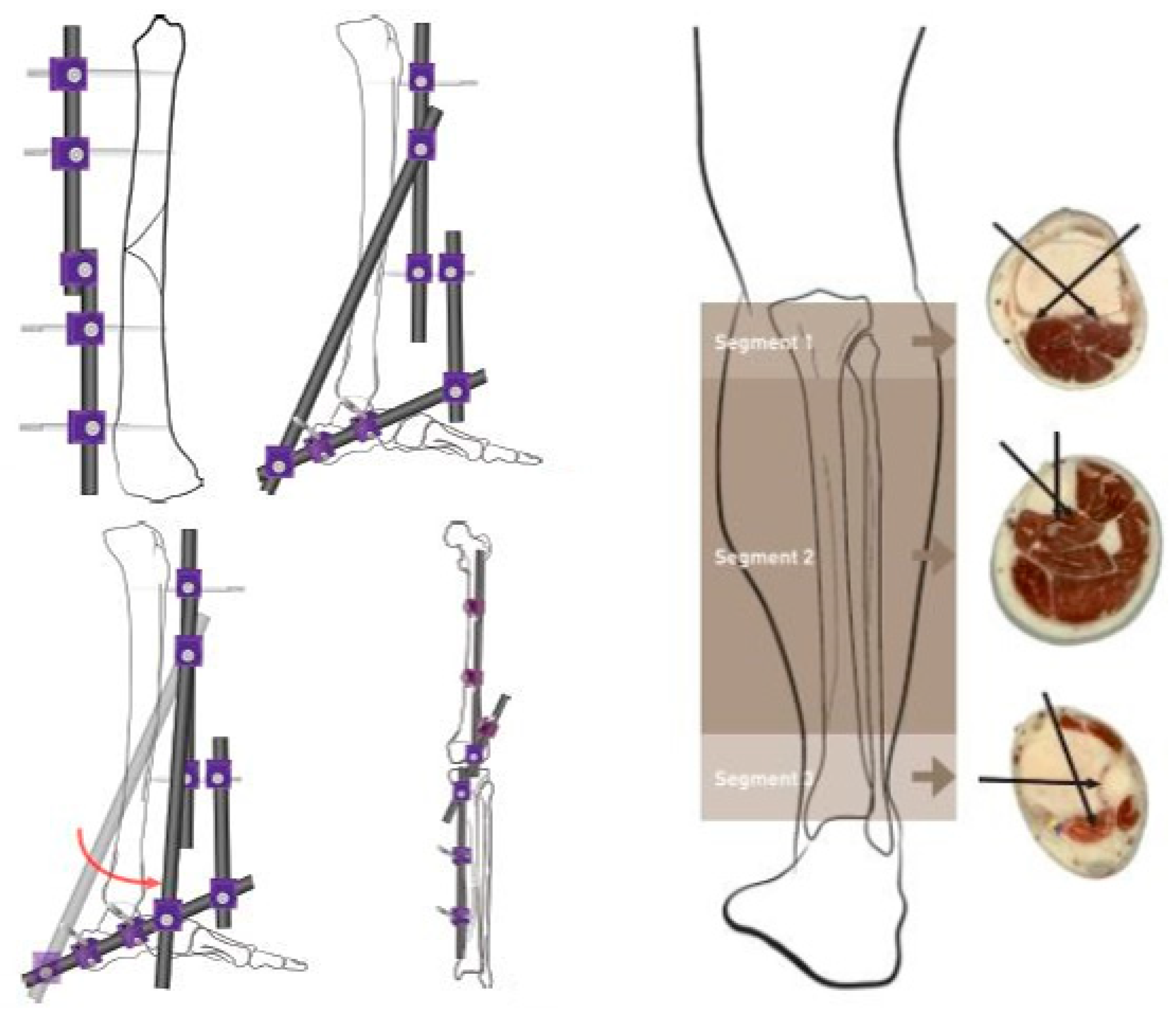 Applied Sciences | Free Full-Text | Biomechanical Evaluation Method to  Optimize External Fixator Configuration in Long Bone Fractures—Conceptual  Model and Experimental Validation Using Pilot Study