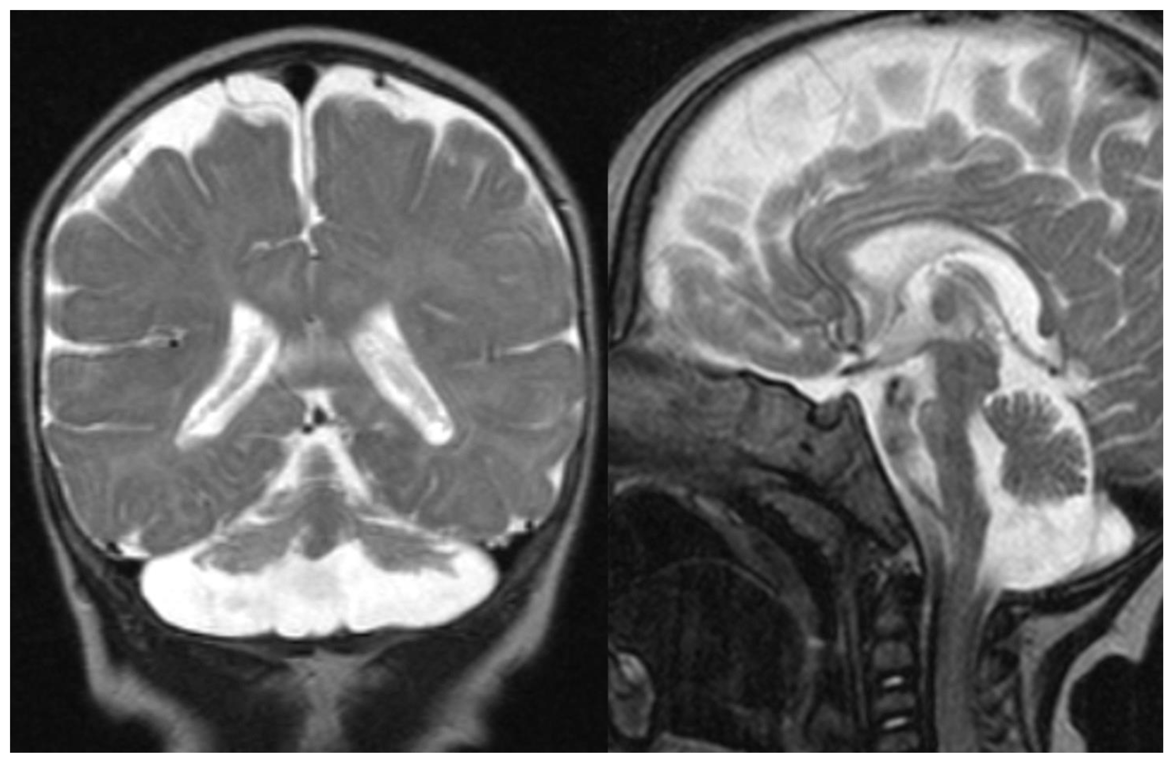 ataxia telangiectasia brain