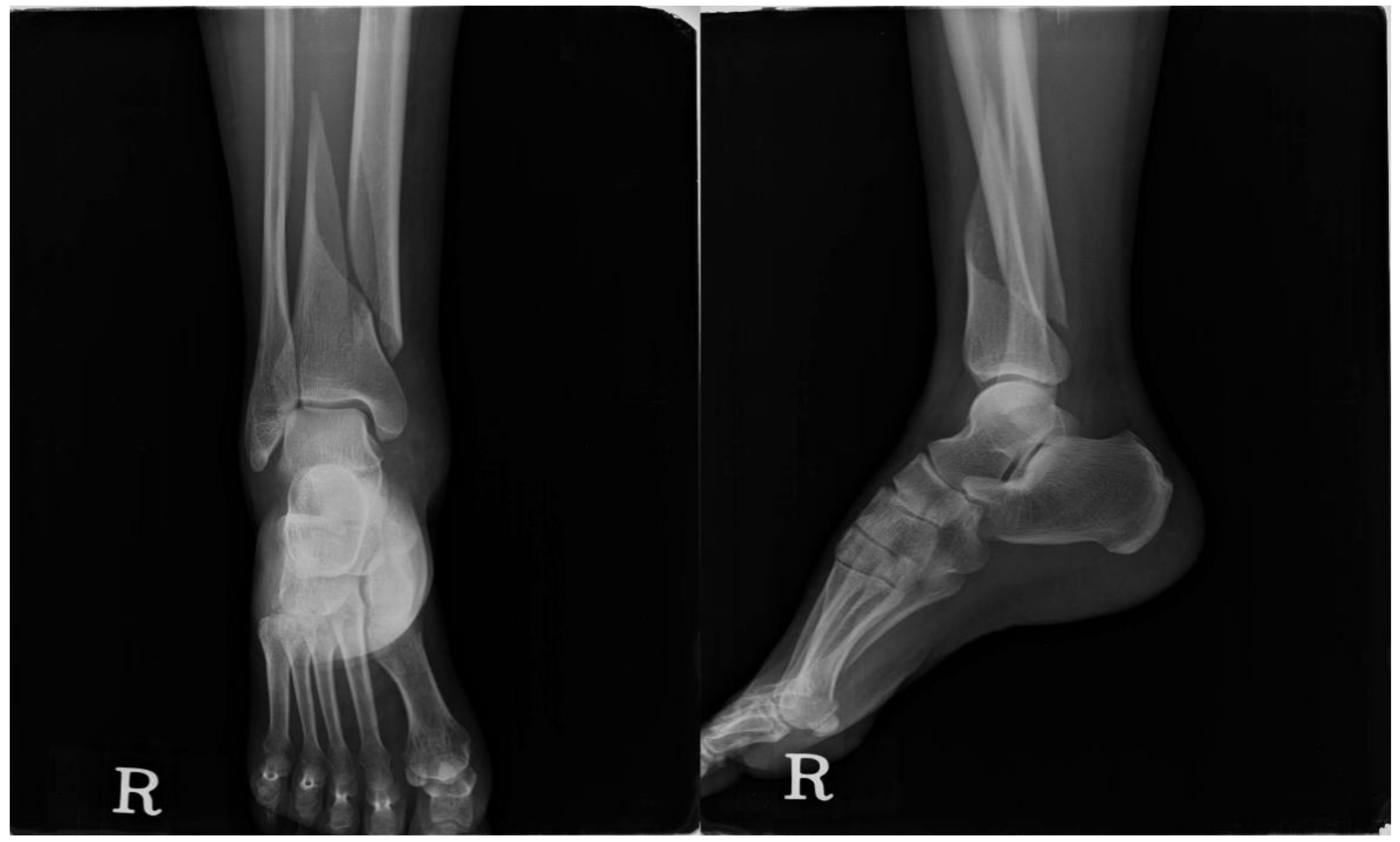 normal pediatric ankle xray