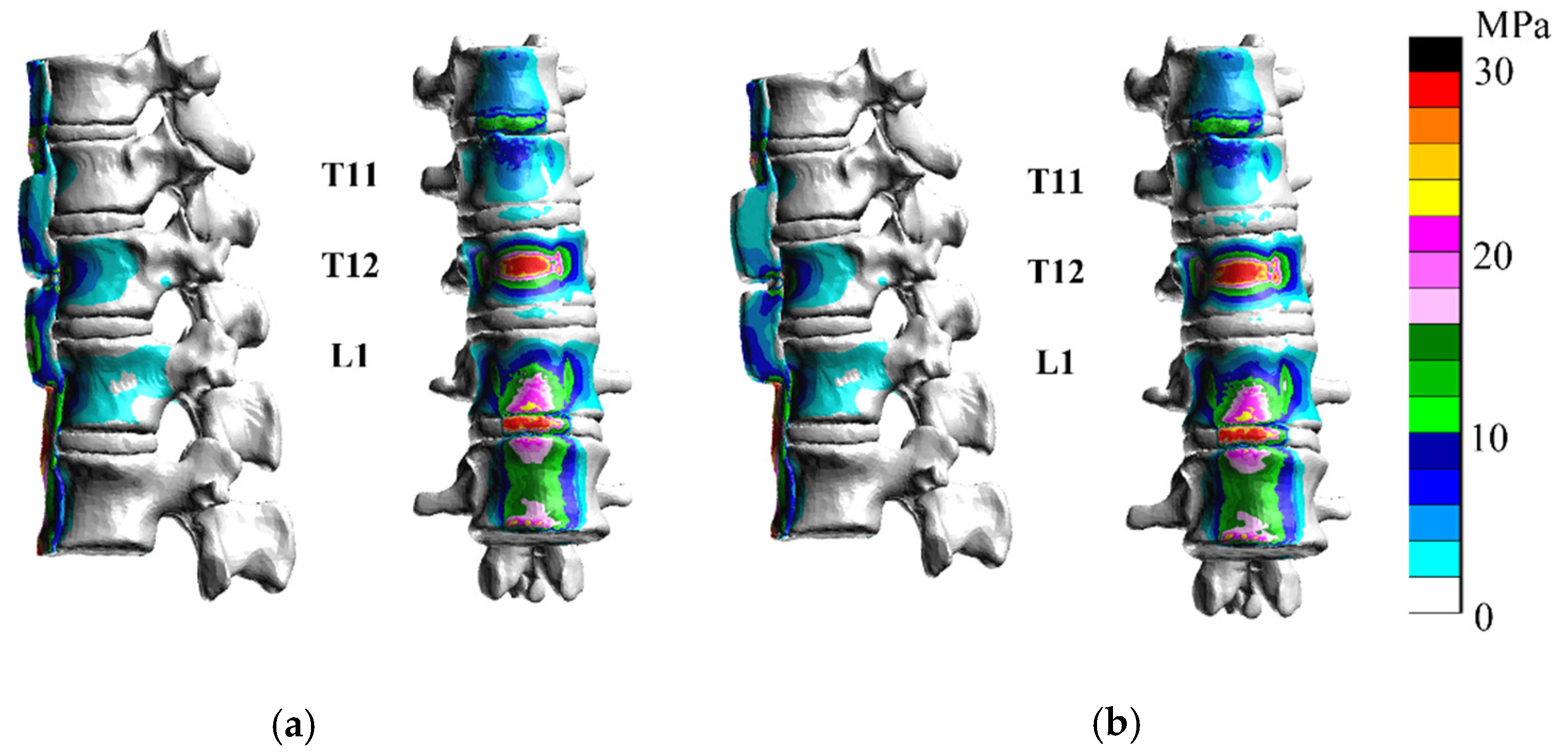 Finite element analysis of compression fractures at the