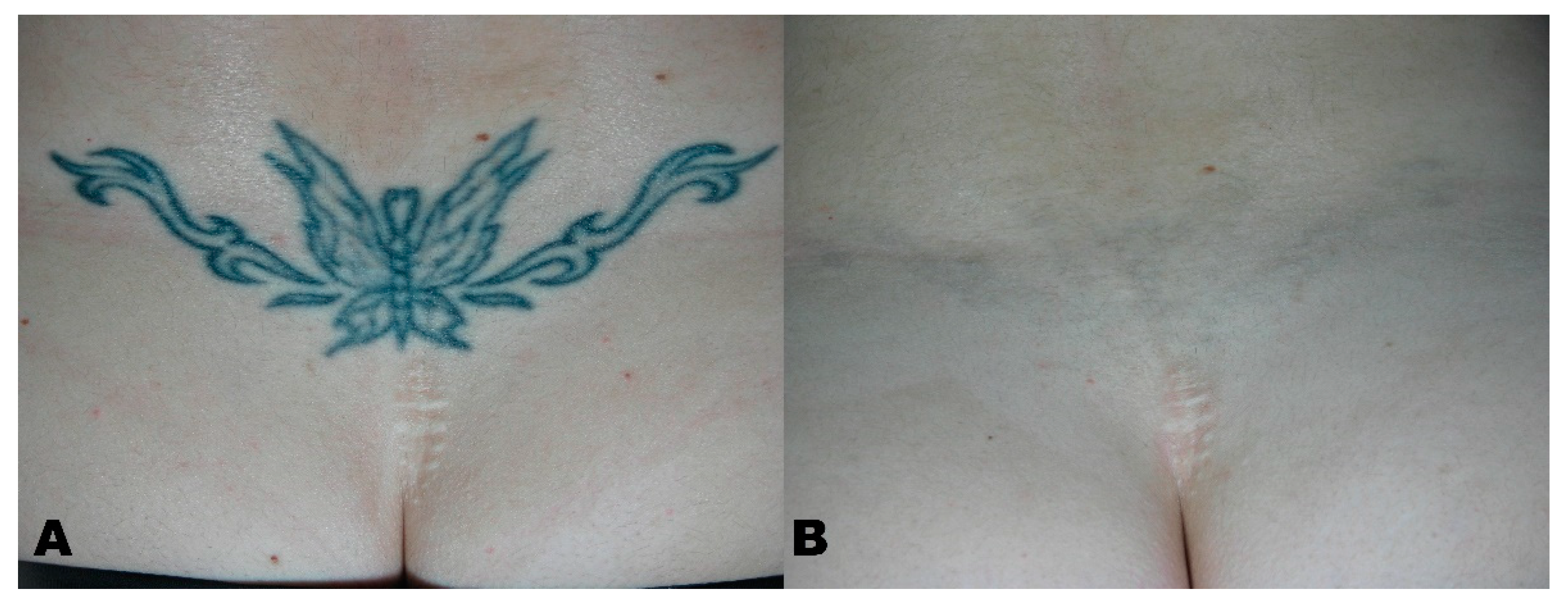 Tattoo removal progress after 25 laser sessions at 5 week intervals. :  r/interestingasfuck