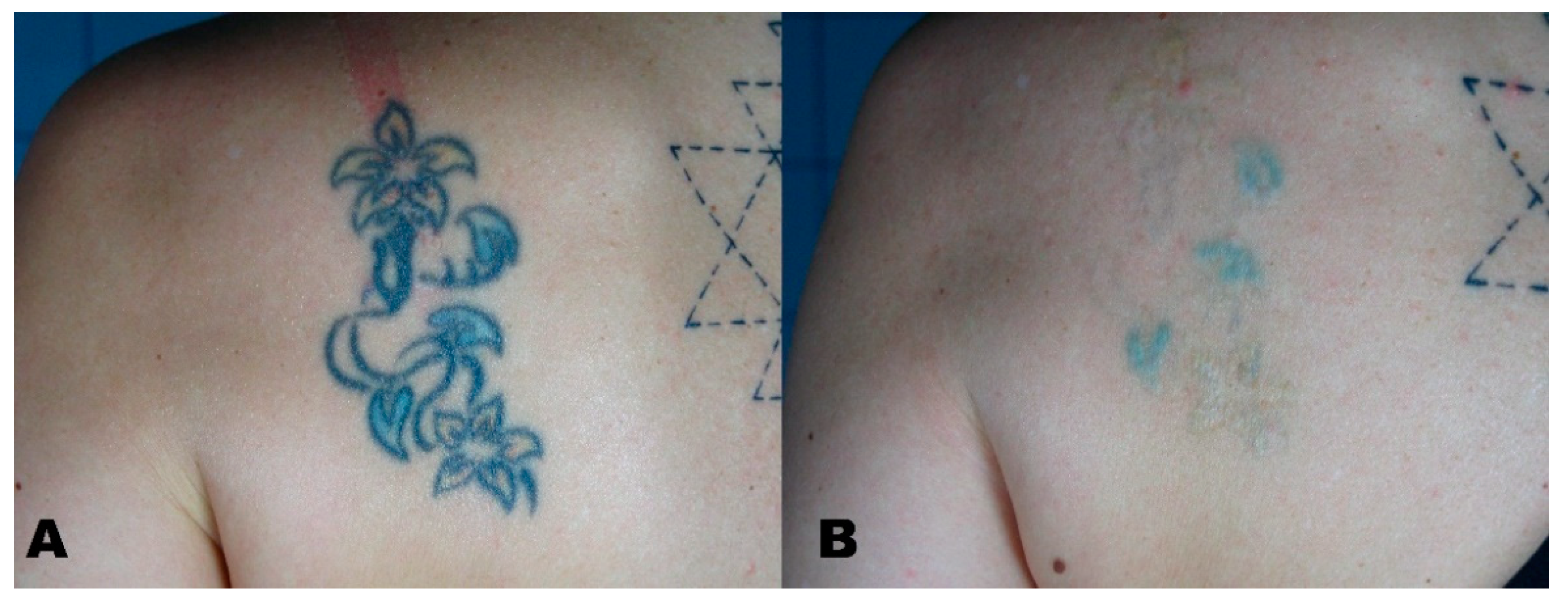 Get Permanent Tattoo Removed Right Away  By Dr Shruti Kohli  Lybrate