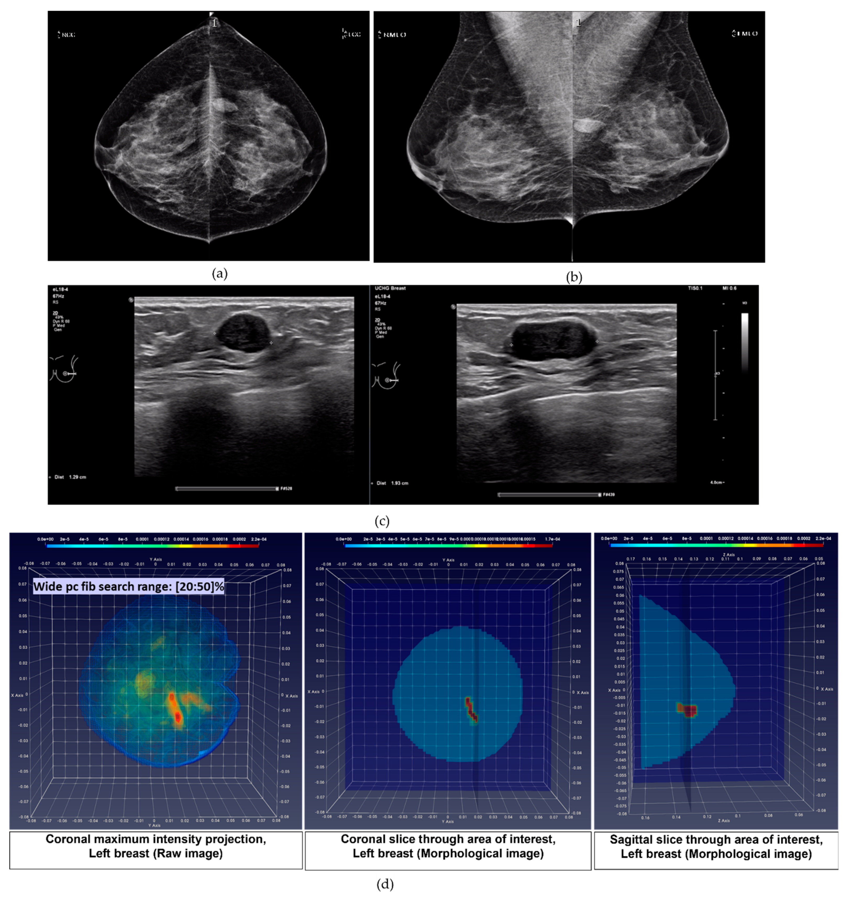 Breast Anatomy, as seen in the Wavelia OBCD scanner: Side view