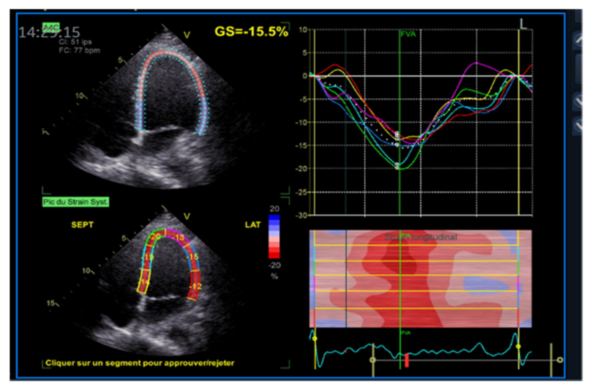 Speckle tracking echocardiography - Wikipedia