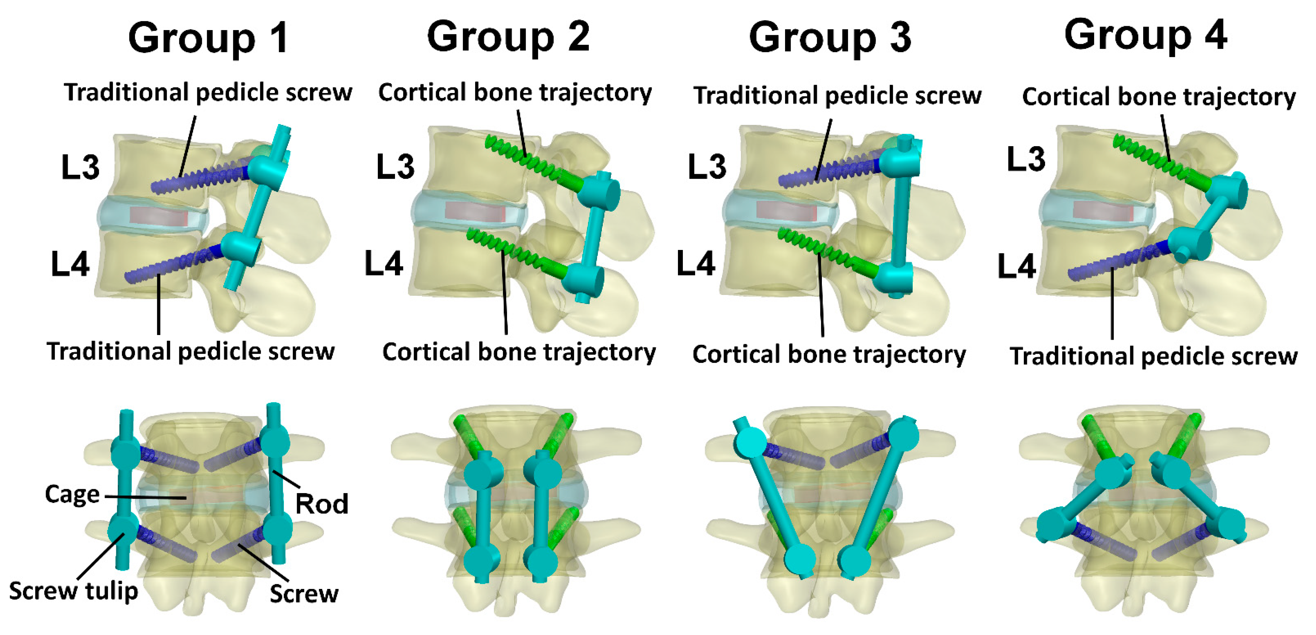 Applied Sciences | Free Full-Text | Biomechanical Evaluation of Cortical  Bone Trajectory Fixation with Traditional Pedicle Screw in the Lumbar  Spine: A Finite Element Study