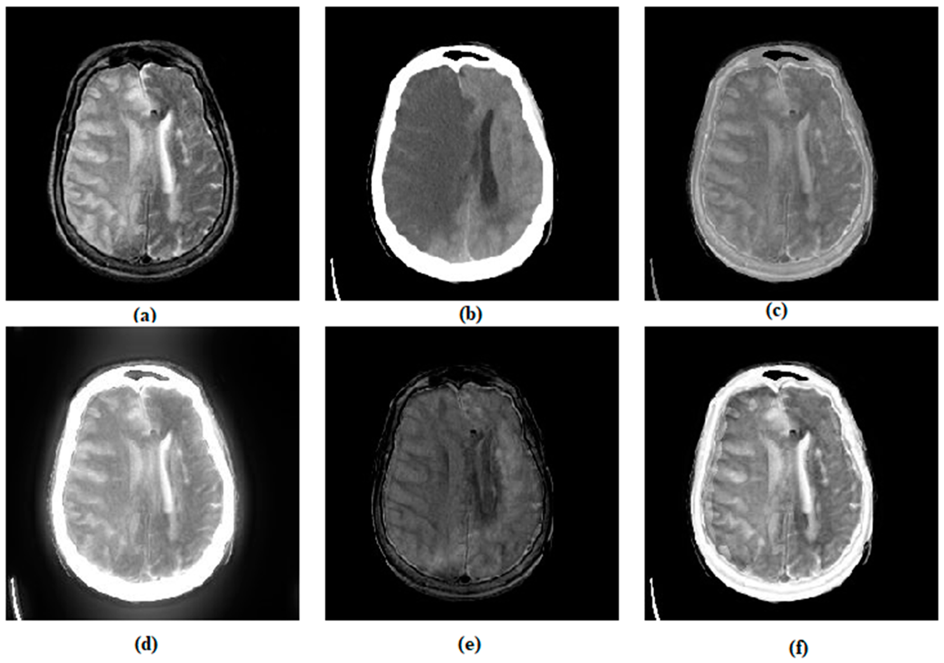 Applied Sciences | Free Full-Text | The Fusion of MRI and CT Medical Images  Using Variational Mode Decomposition | HTML