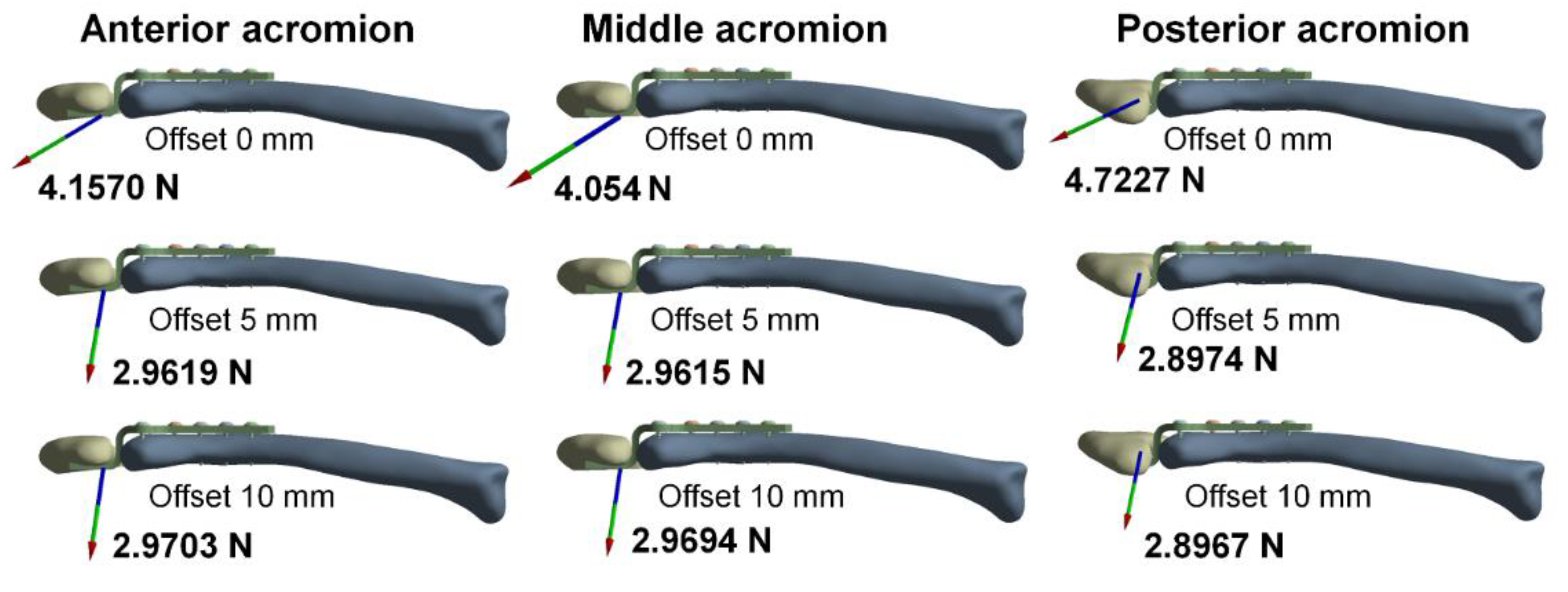 Biomechanical effects of different numbers and locations of screw-in  clavicle hook plates. - Abstract - Europe PMC