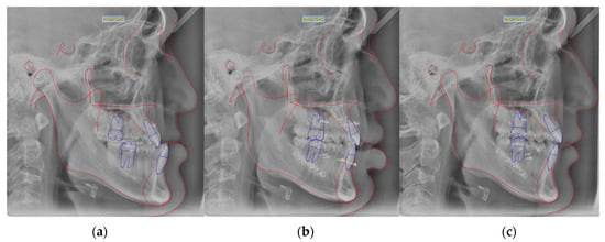 Postoperative Stability Of Patients Undergoing Orthognathic Surgery ...