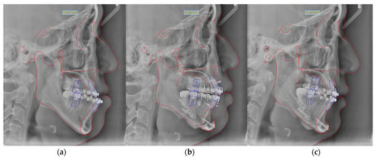 Postoperative Stability Of Patients Undergoing Orthognathic Surgery ...