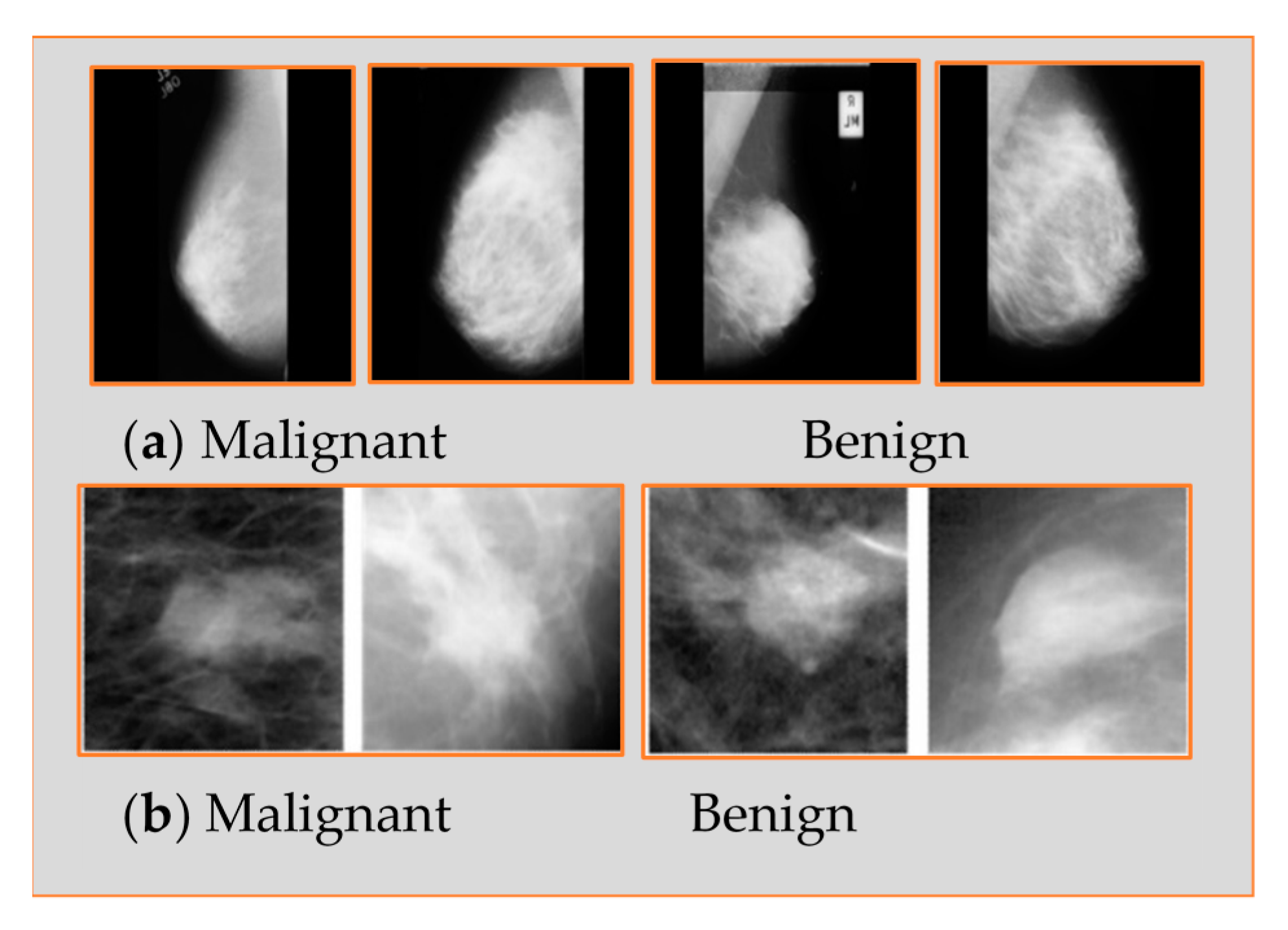 Applied Sciences Free Full Text Breast Cancer Detection Using Mammogram Images With Improved