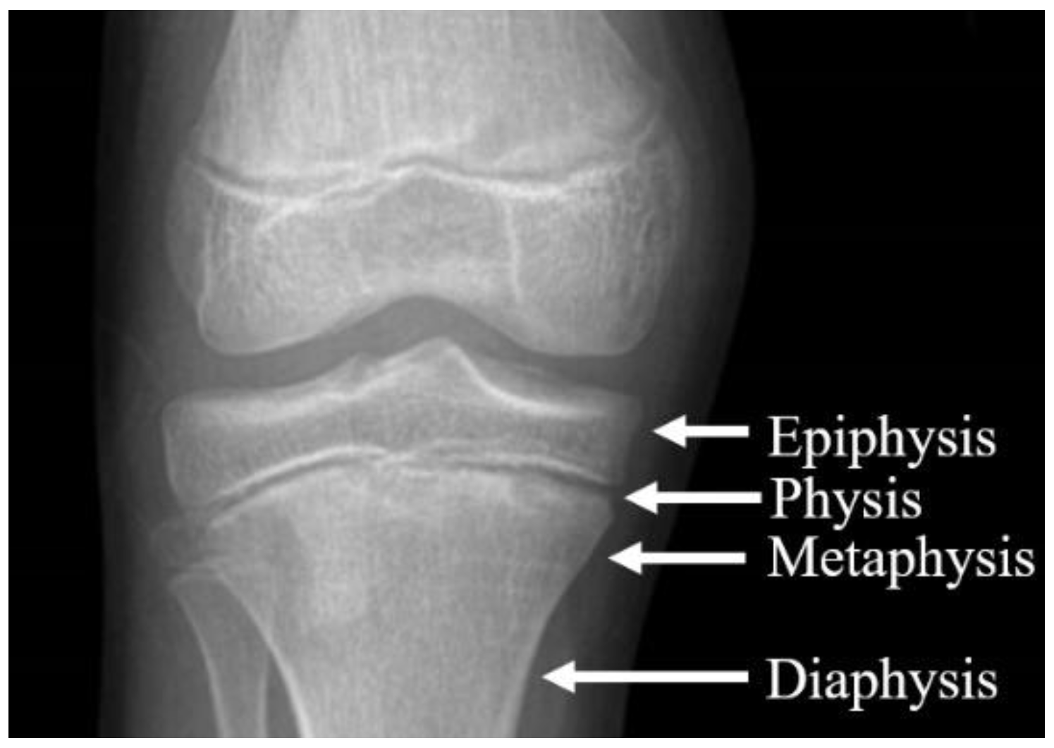 Applied Sciences | Free Full-Text | Biomechanical Analysis of Staples for  Epiphysiodesis
