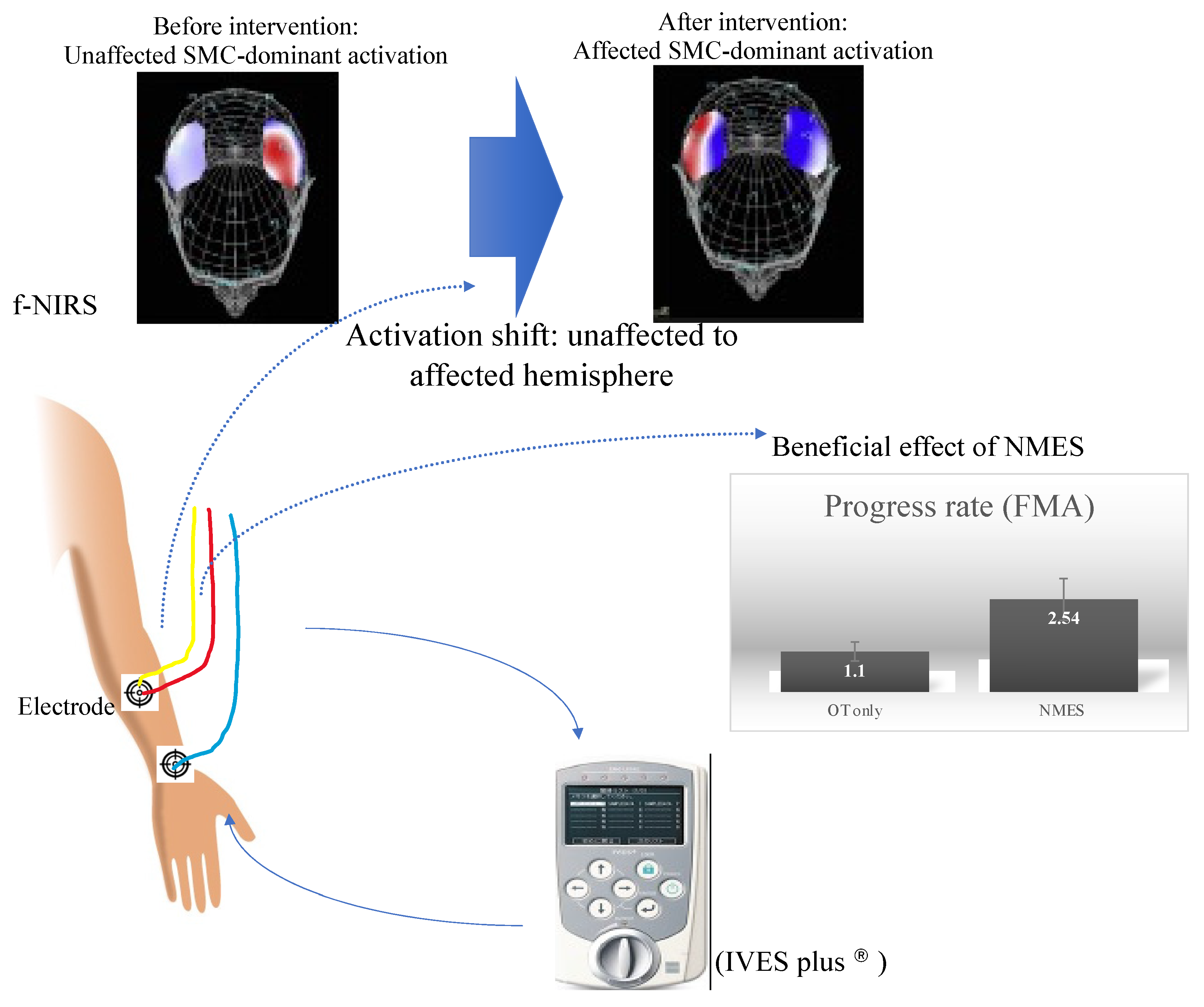 Applied Sciences | Free Full-Text | Neuromuscular Stimulation as an  Intervention Tool for Recovery from Upper Limb Paresis after Stroke and the  Neural Basis