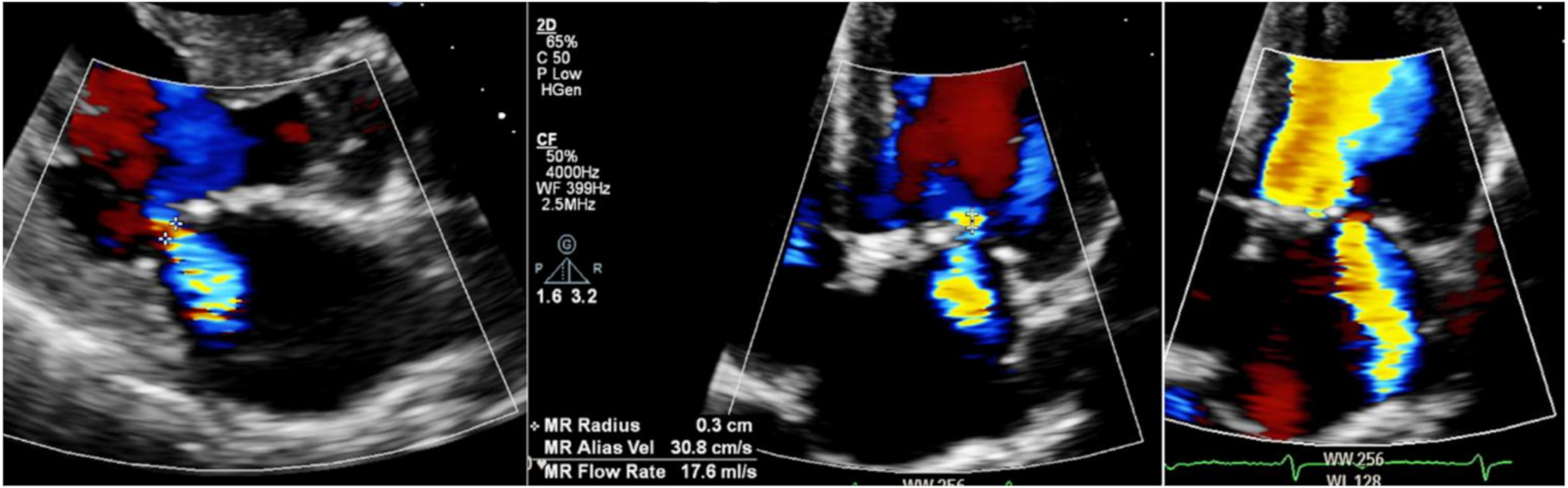 Echocardiography in Anderson-Fabry Disease