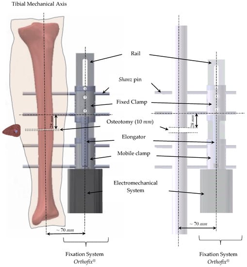 Applied Sciences | Free Full-Text | Evaluation of Bone Consolidation in  External Fixation with an Electromechanical System