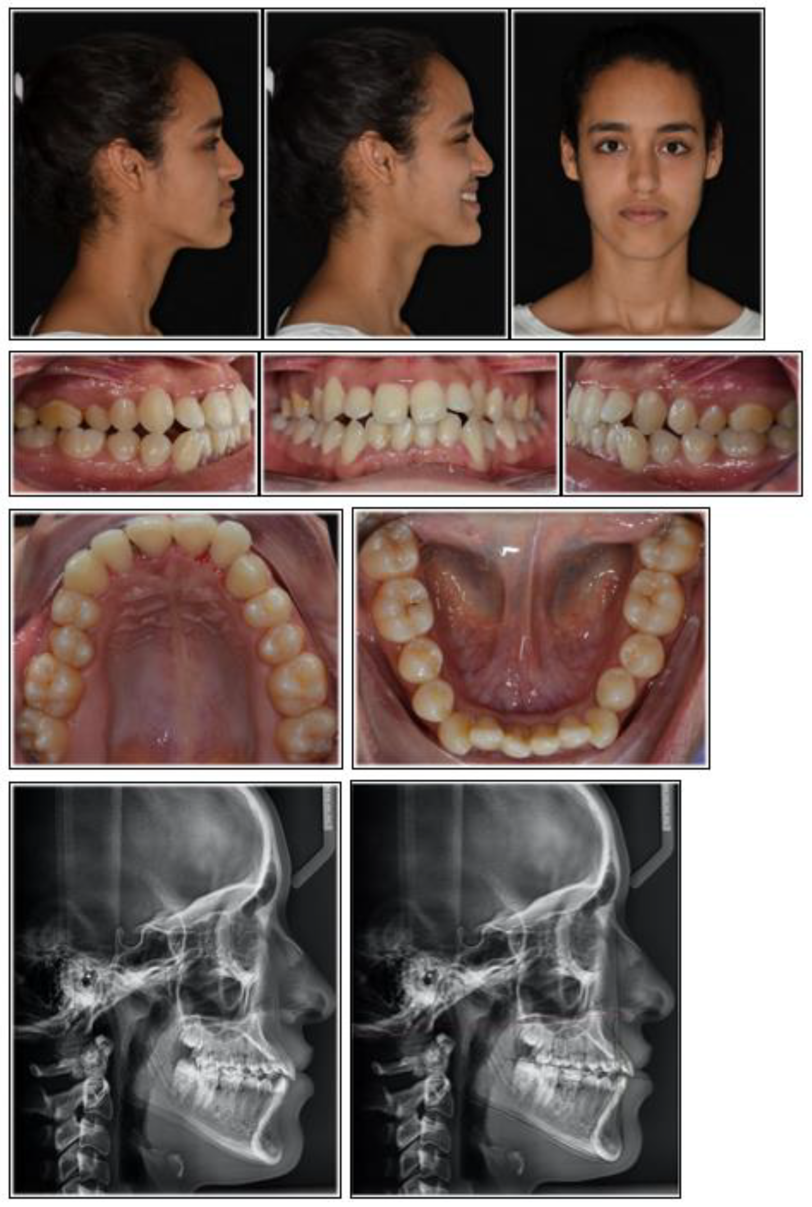 Applied Sciences | Free Full-Text | Management of Class III Extraction with  the Miniscrew-Supported Orthodontic Pseudo-Ankylosis (MSOPA) Using Direct  Tads