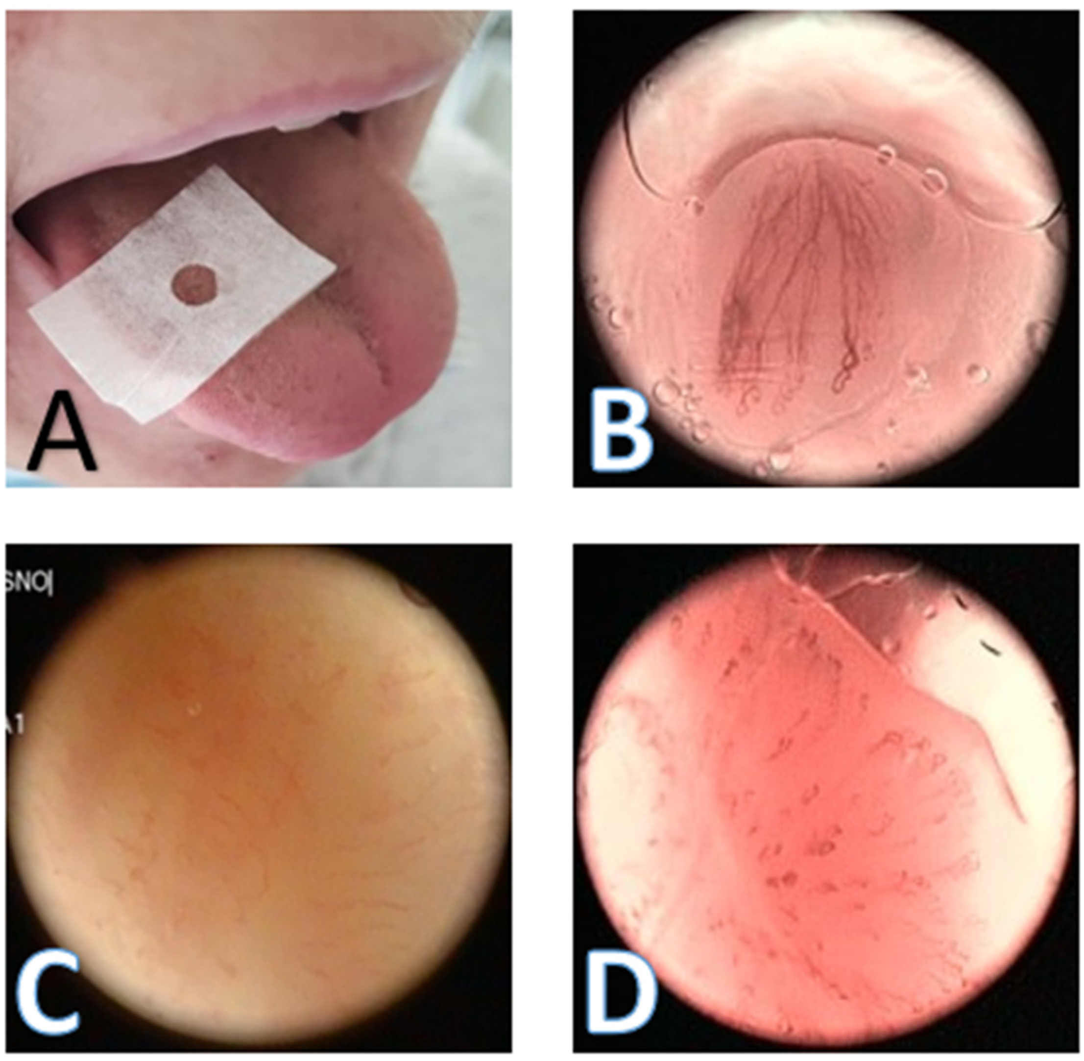 Complications of stapes surgry