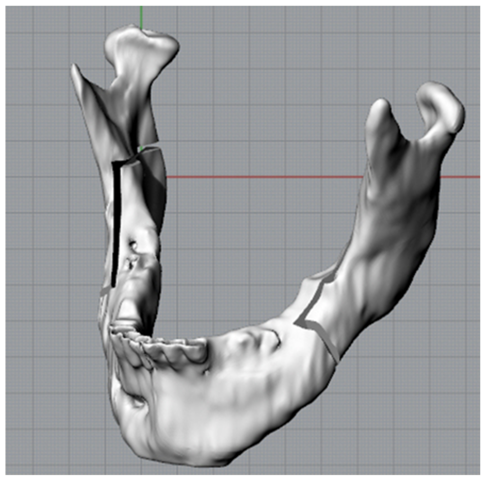 Applied Sciences | Free Full-Text | Computer Aided Orthognathic Surgery: A  General Method for Designing and Manufacturing Personalized  Cutting/Repositioning Templates | HTML