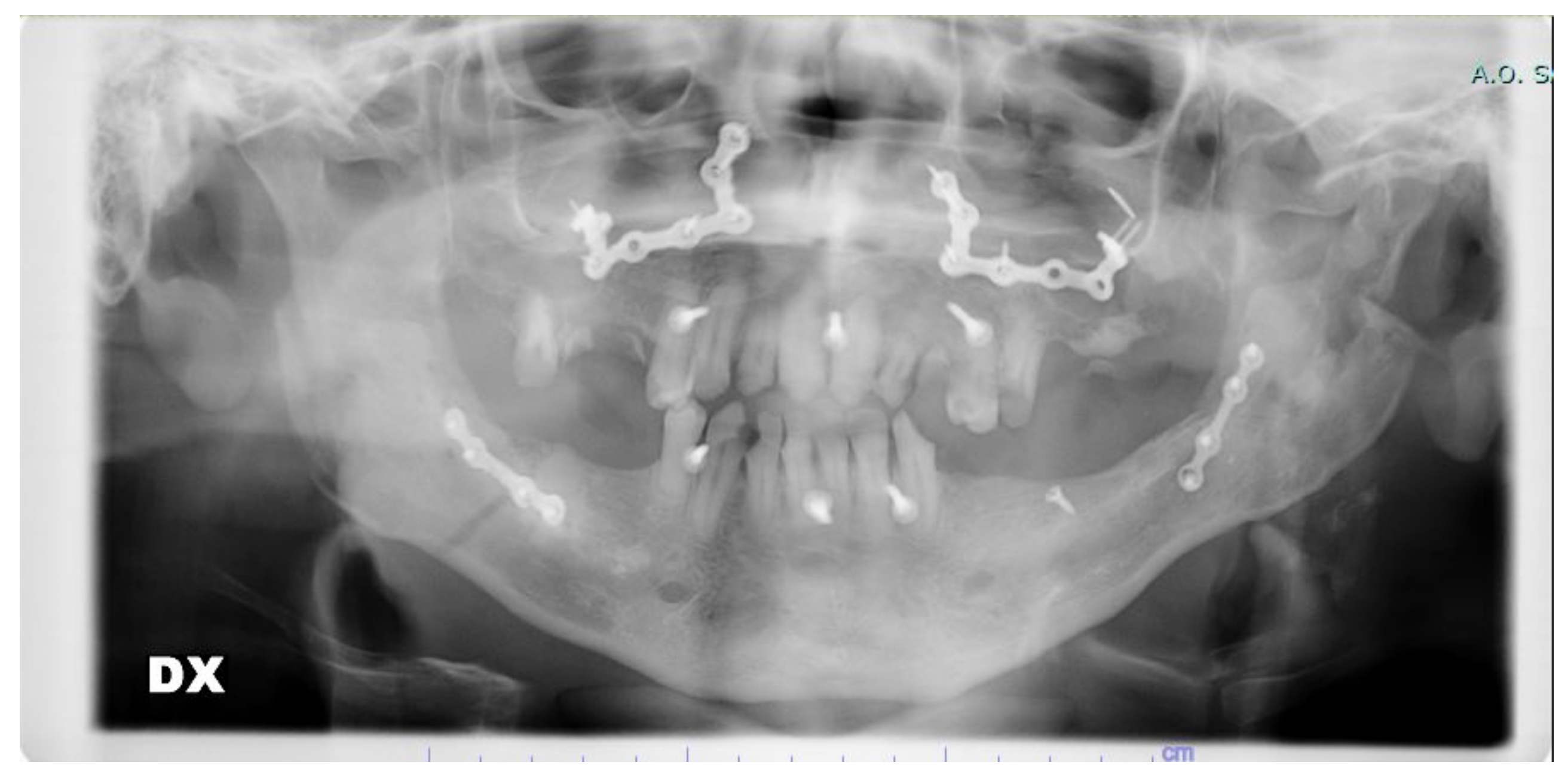 Mike Napoli: Bimaxillary Advancement Surgery - Surgical Sleep Solution