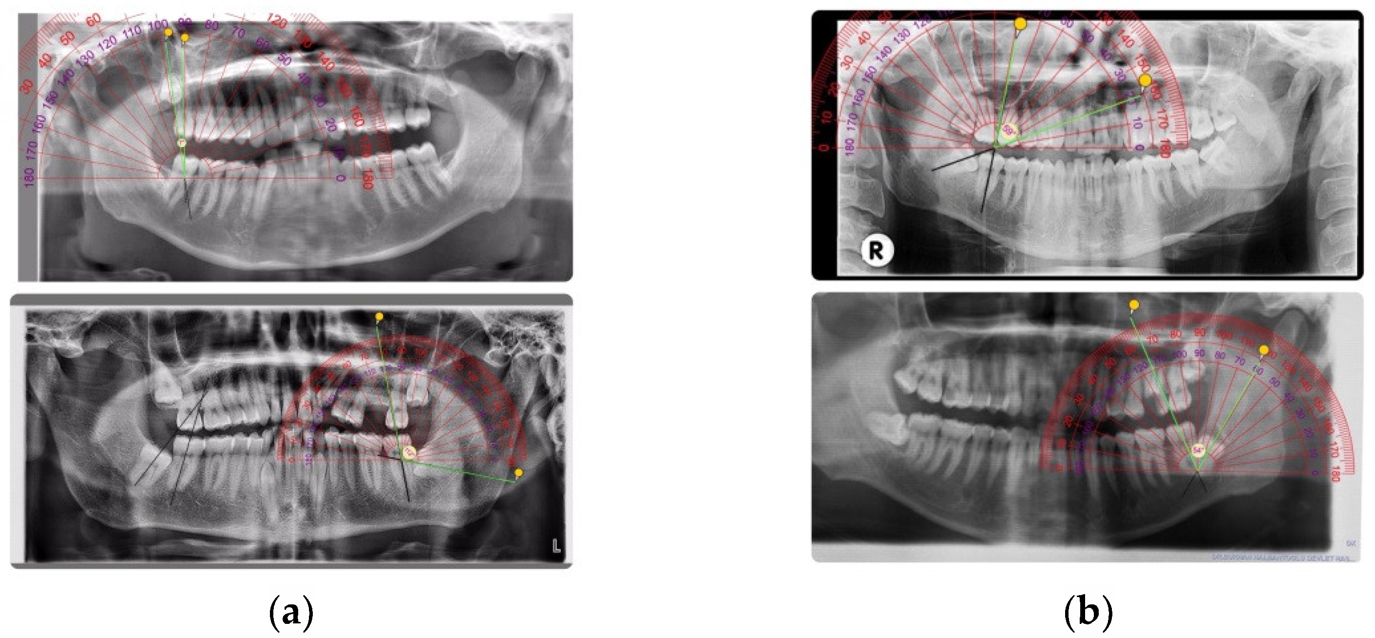 Comparison of dental anomalies between the groups with impacted