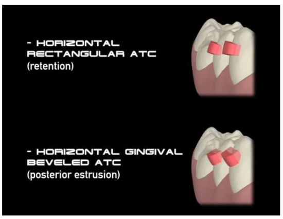 Invisalign, Palmieri Orthodontics