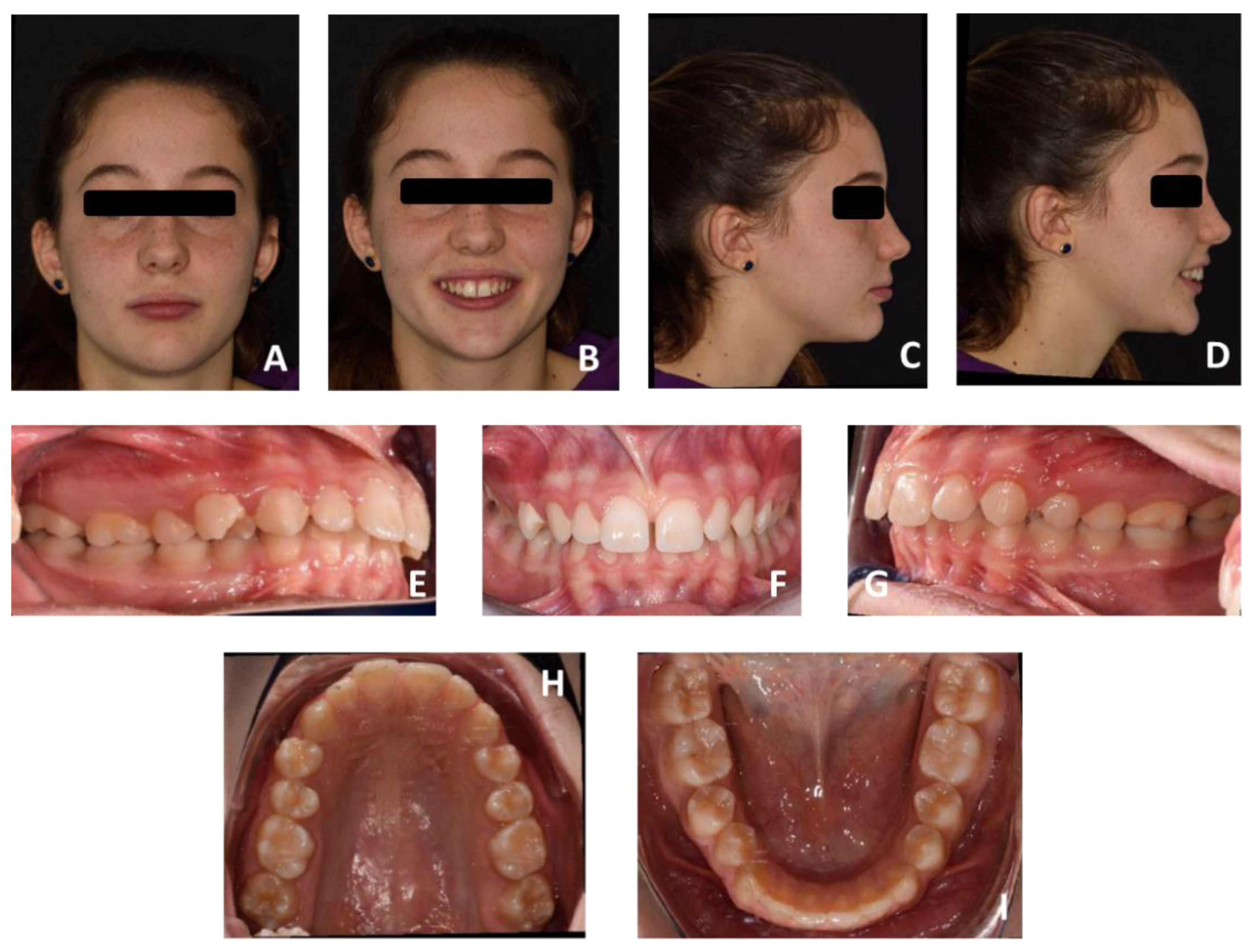 Family Braces - 😢 Problem: Significant Overbite, Deep Bite, Bad Bite at  the Back, and Upper/Lower Crowding 👩🏻‍⚕️ Solution: Bite Corrector +  Invisalign 📆 Treatment Length: 17 months 😁 Results: an Outstanding
