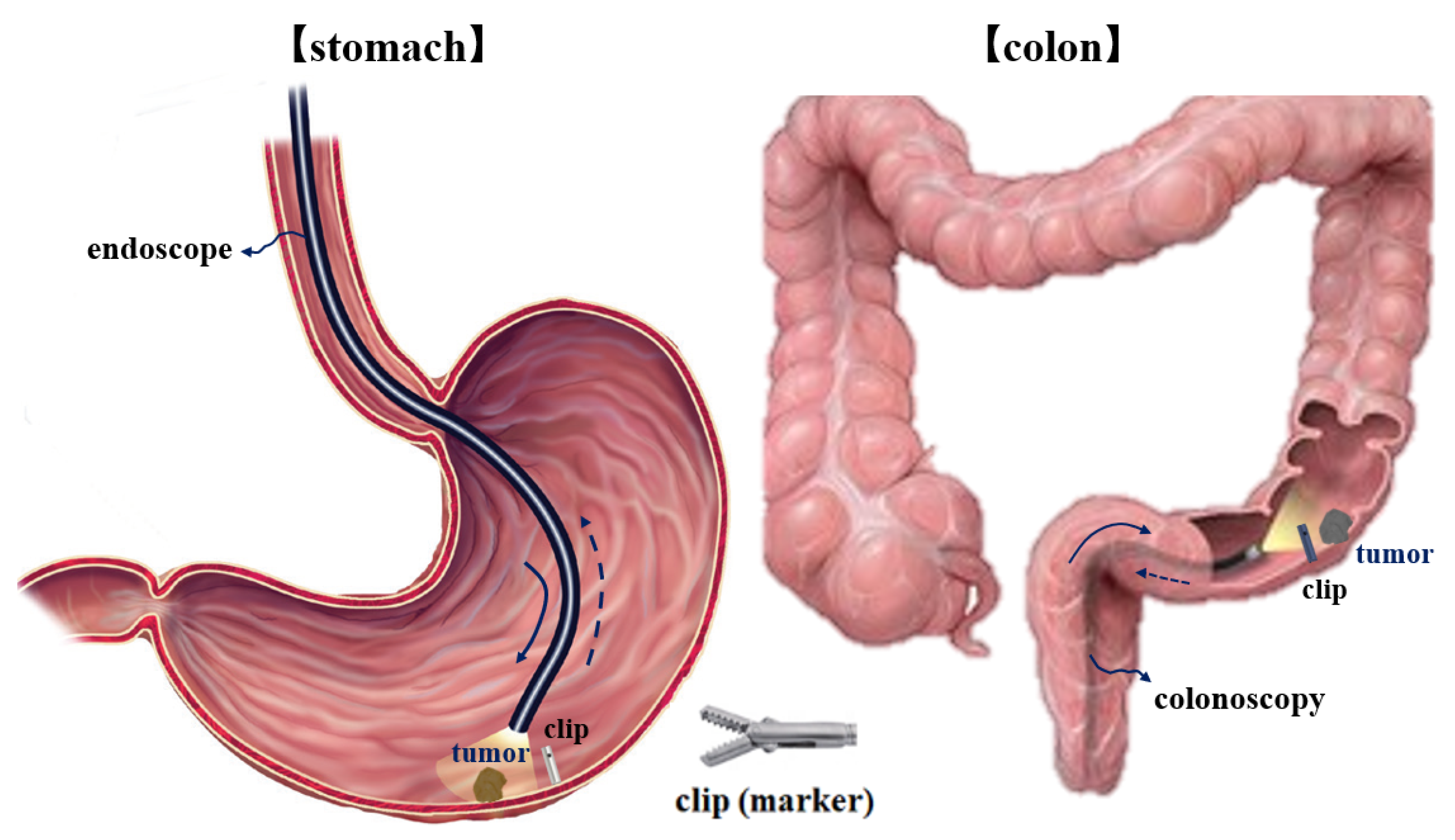 Applied Sciences | Free Full-Text | A Metal Detector for Clip Location  Tracking of Stomach and Colon Cancer during Laparoscopic Surgery