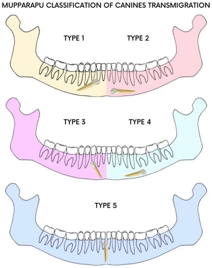 Angle's classification: Class II, Division 2, Introduction to dental  occlusion, Dental Anatomy, , Learn anatomy