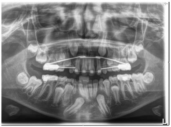 Orthodontic traction of a retained upper canine with Edgewise appliances:  Case report