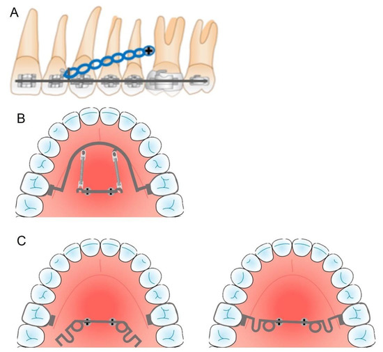 Do you know that minivis can help shorten the period of treatment in  orthodontics? 