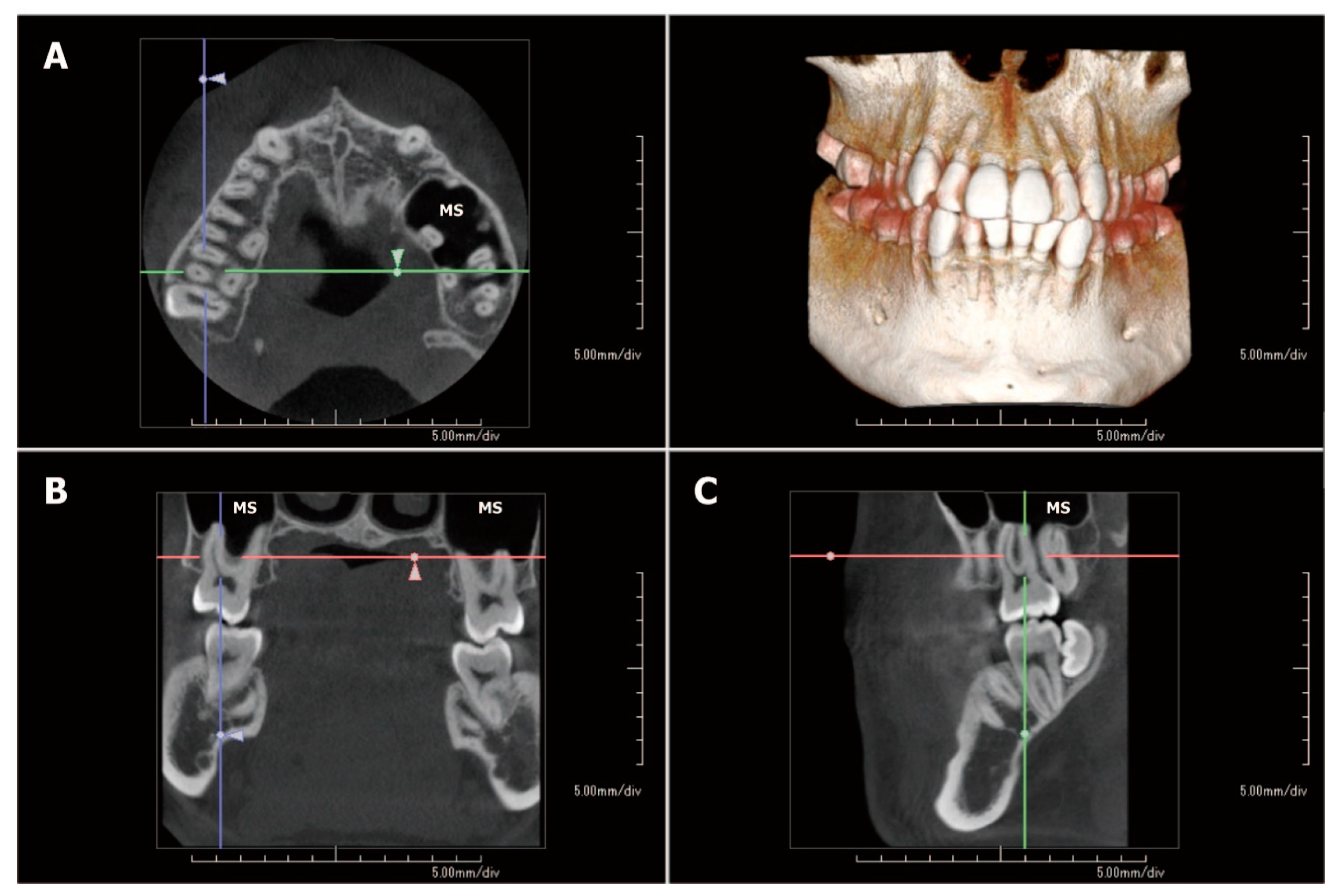 A Case Treated with Maxillary Molar Distalization through the Maxillary ...