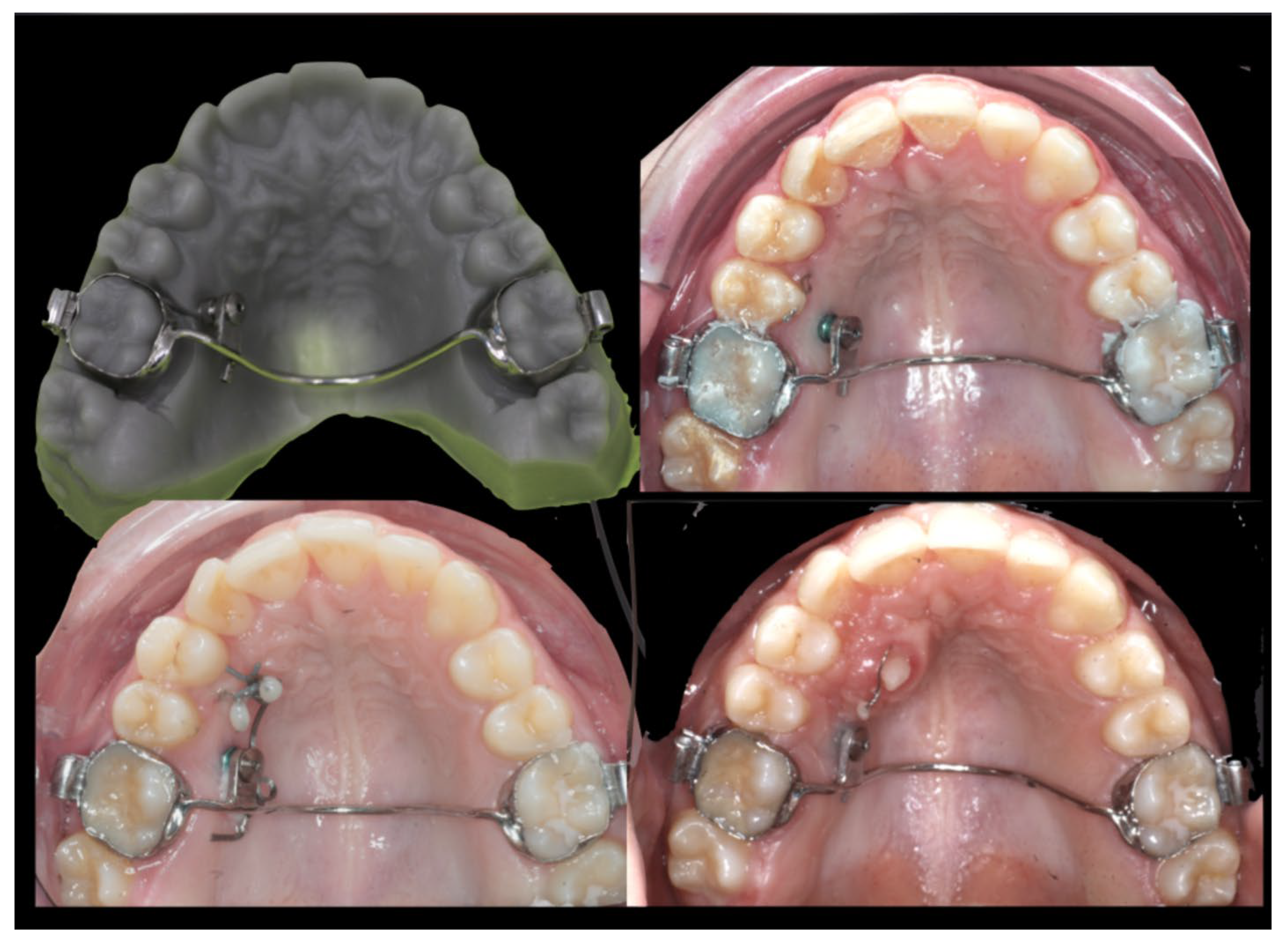 Laceback demo ant. anchorage control prevention of canine mesial tipping  clinical tips- orthodontics 