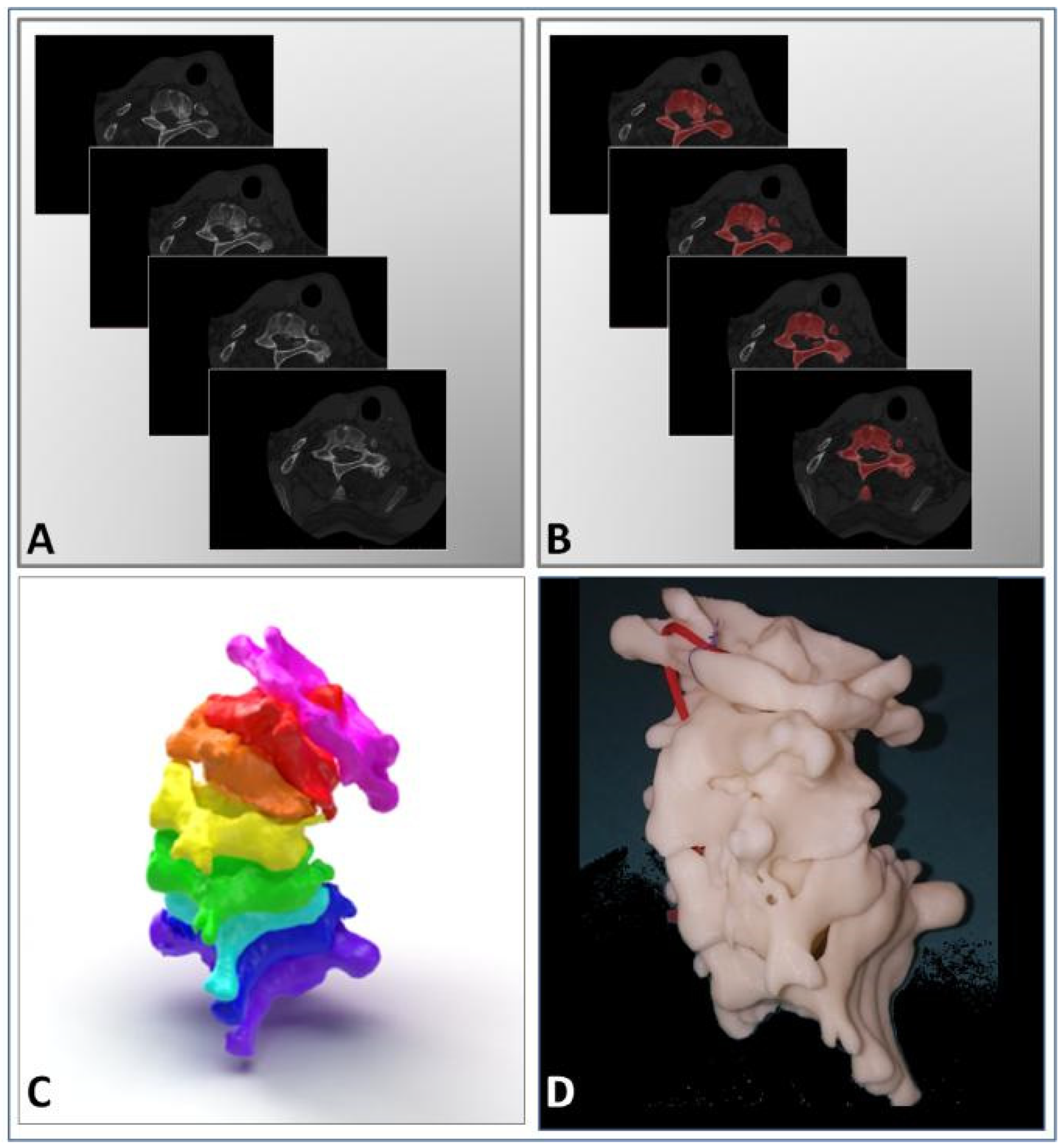 Applied Sciences | Free Full-Text | 3D Printing in Surgical Planning and  Intra-Operative Assistance: A Case Report on Cervical Deformity Correction  Surgery