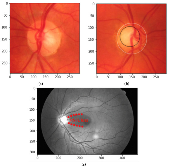 RNFL Analysis in the Diagnosis of Glaucoma - Glaucoma Today