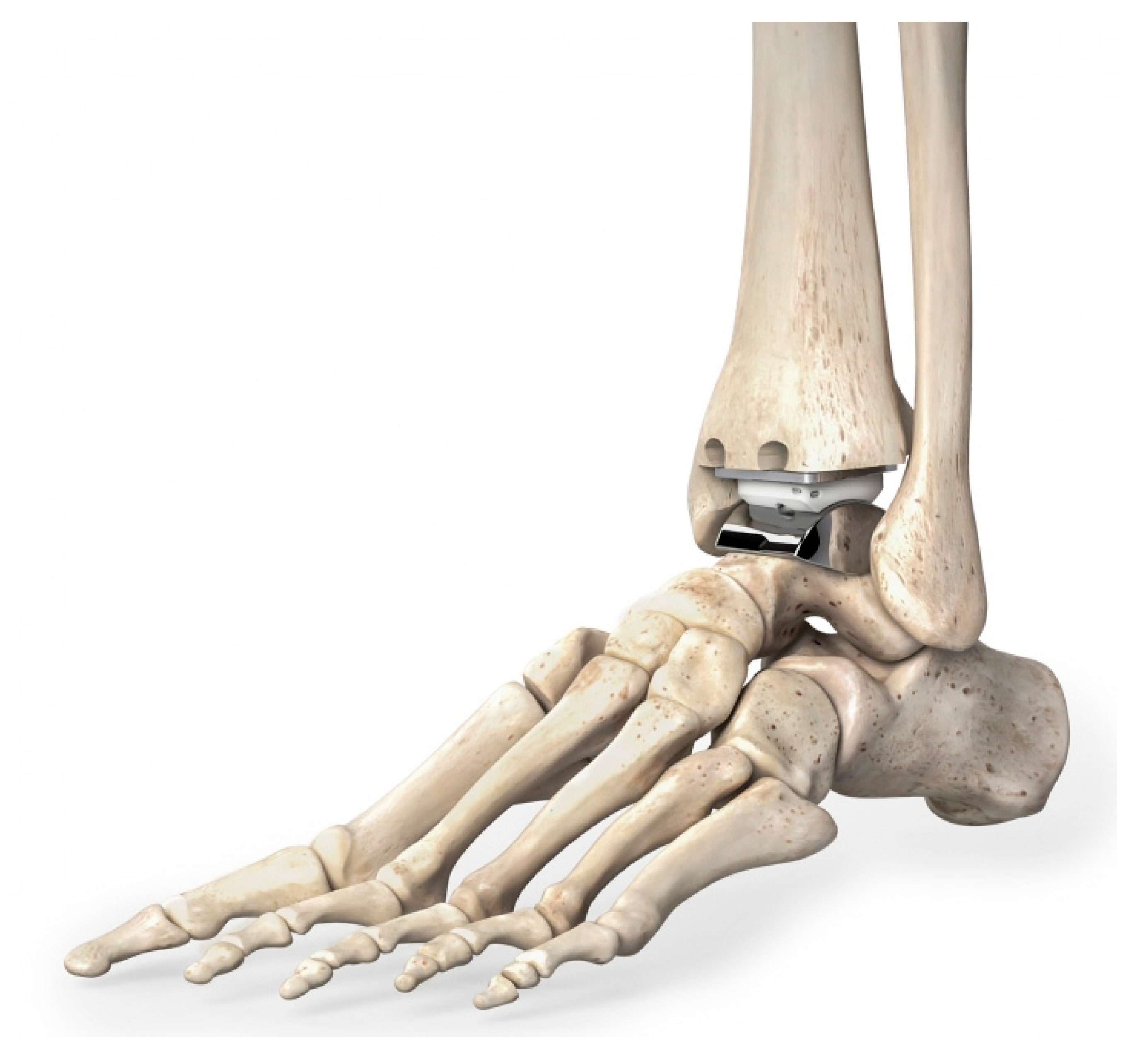 Ankle Joint Replacement San Antonio