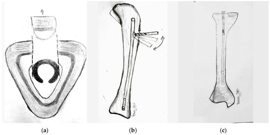 Difficulties Encountered in Removing a Tibial Intramedullary Nail in a  Healed Tibial Fracture | Semantic Scholar