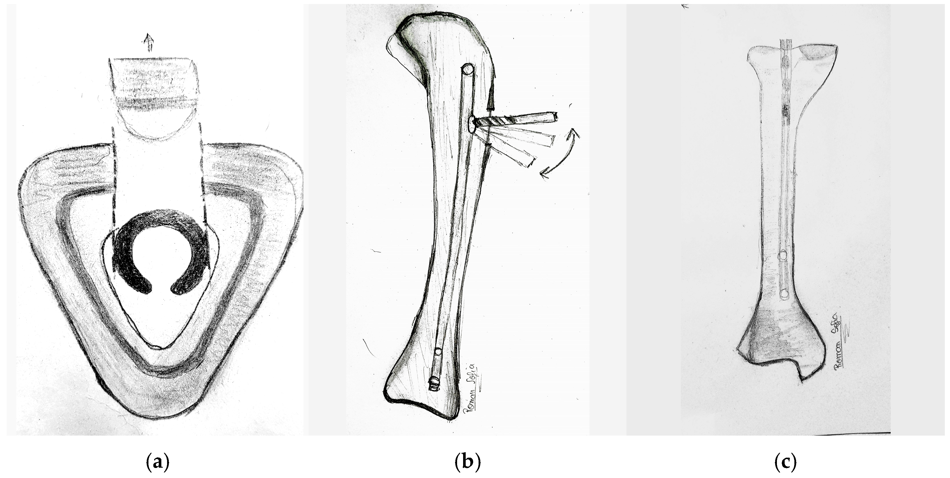 X-ray of distal tibia fractures operated with interlocking... | Download  Scientific Diagram