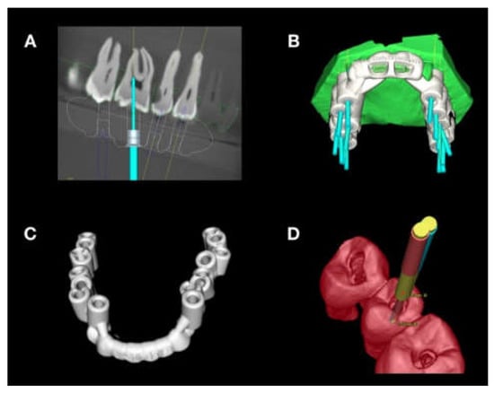 Guided Endodontics Versus Conventional Access Cavity, 44% OFF