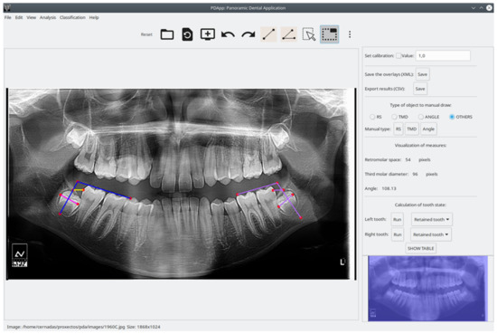 Validation Analysis of Panoramic Dental Application (PDApp 