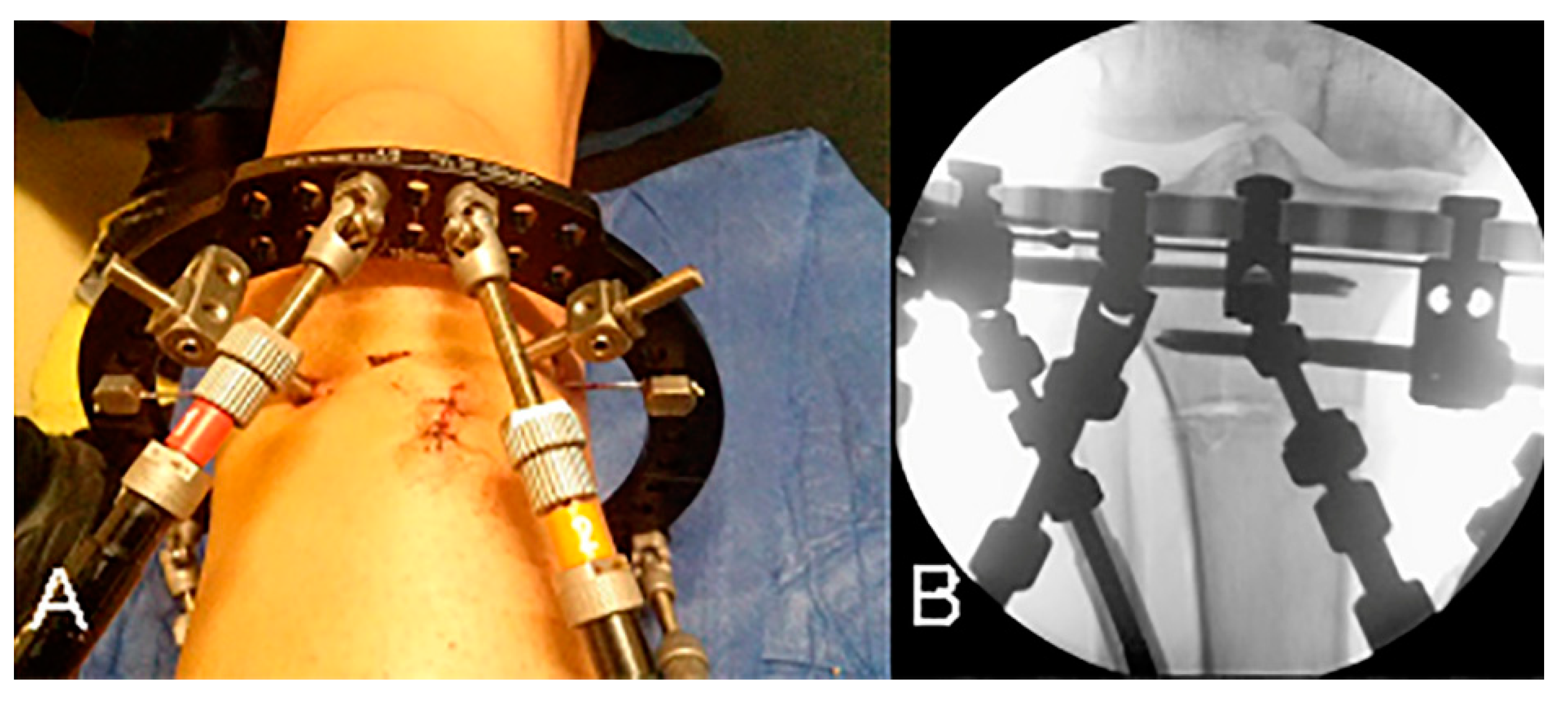 Minimally invasive distal tibial osteotomy and correction of deformity with  the Taylor Spatial Frame – Orthoracle LuanMD