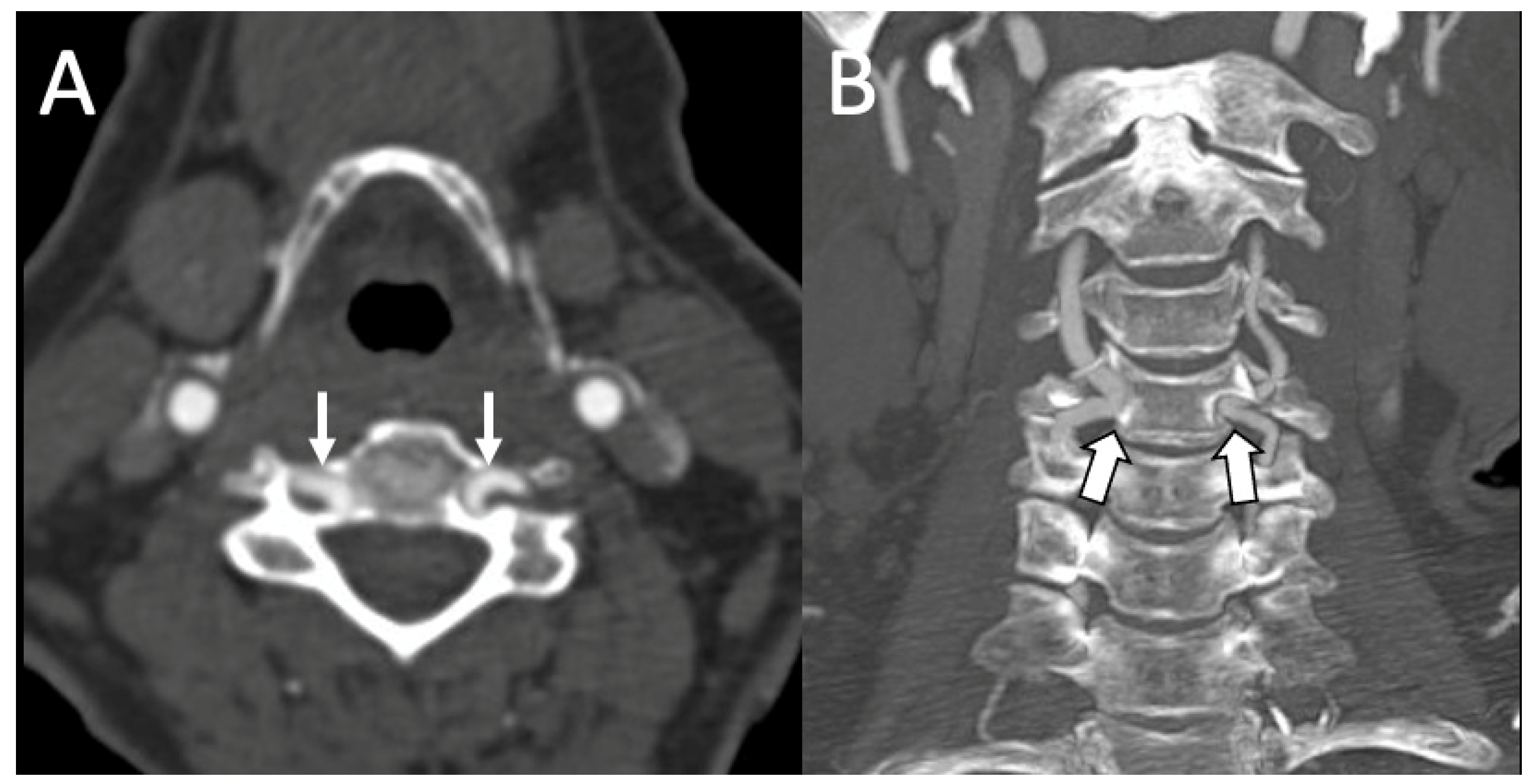 Applied Sciences Free Full Text Radiological Assessment Of Extracranial Vertebral Artery