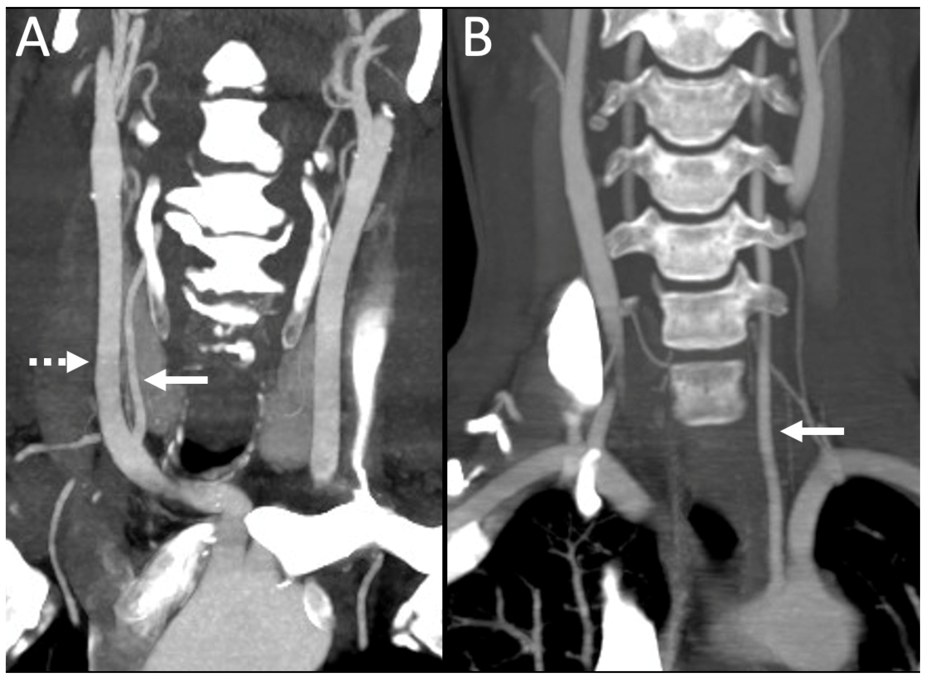 Applied Sciences Free Full Text Radiological Assessment Of Extracranial Vertebral Artery 5947