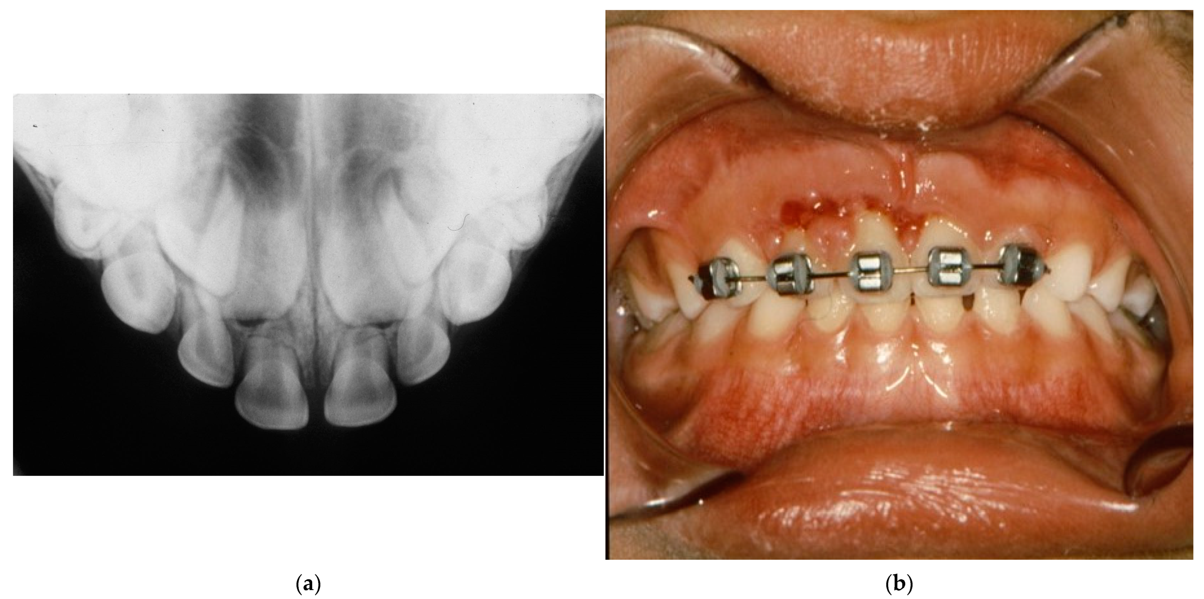 Applied Sciences | Free Full-Text | A Retrospective Cohort Study of  Traumatic Root Fractures in Primary Dentition: Can Splinting Type Improve  Therapeutic Outcomes?