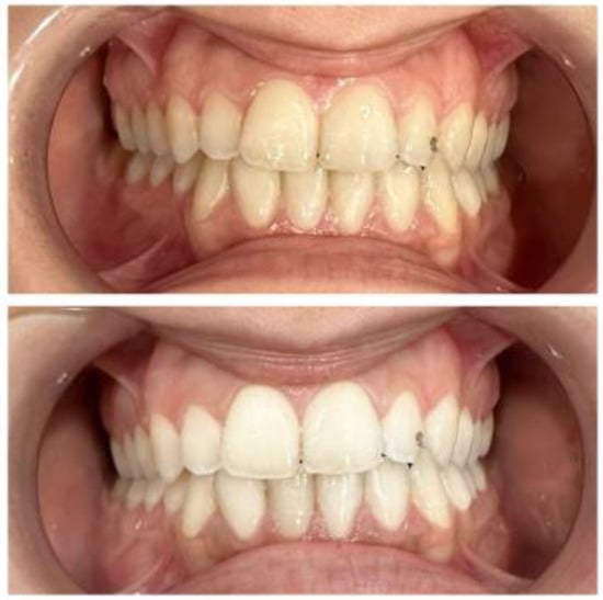 Bleaching of Non-vital Discolored Teeth: Keys of Success - Dental News