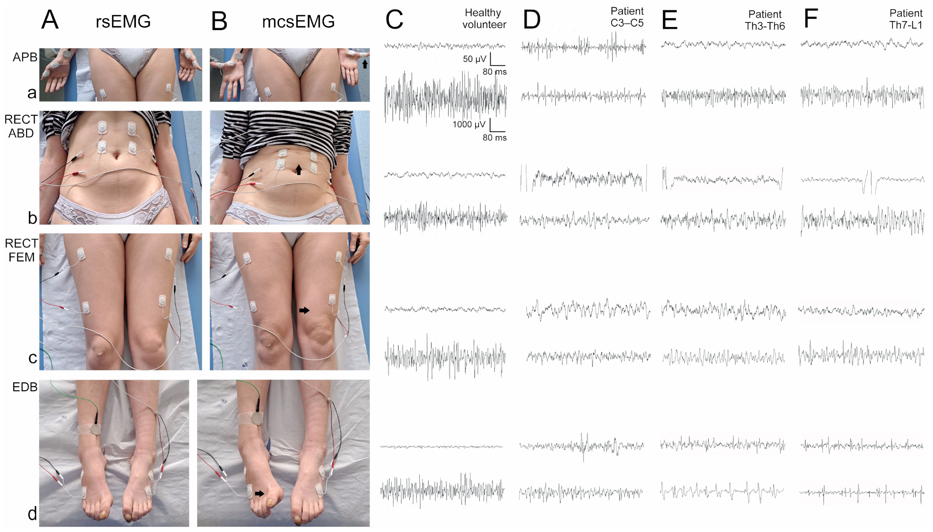 Association between trunk muscle mass and log for visual analog scale