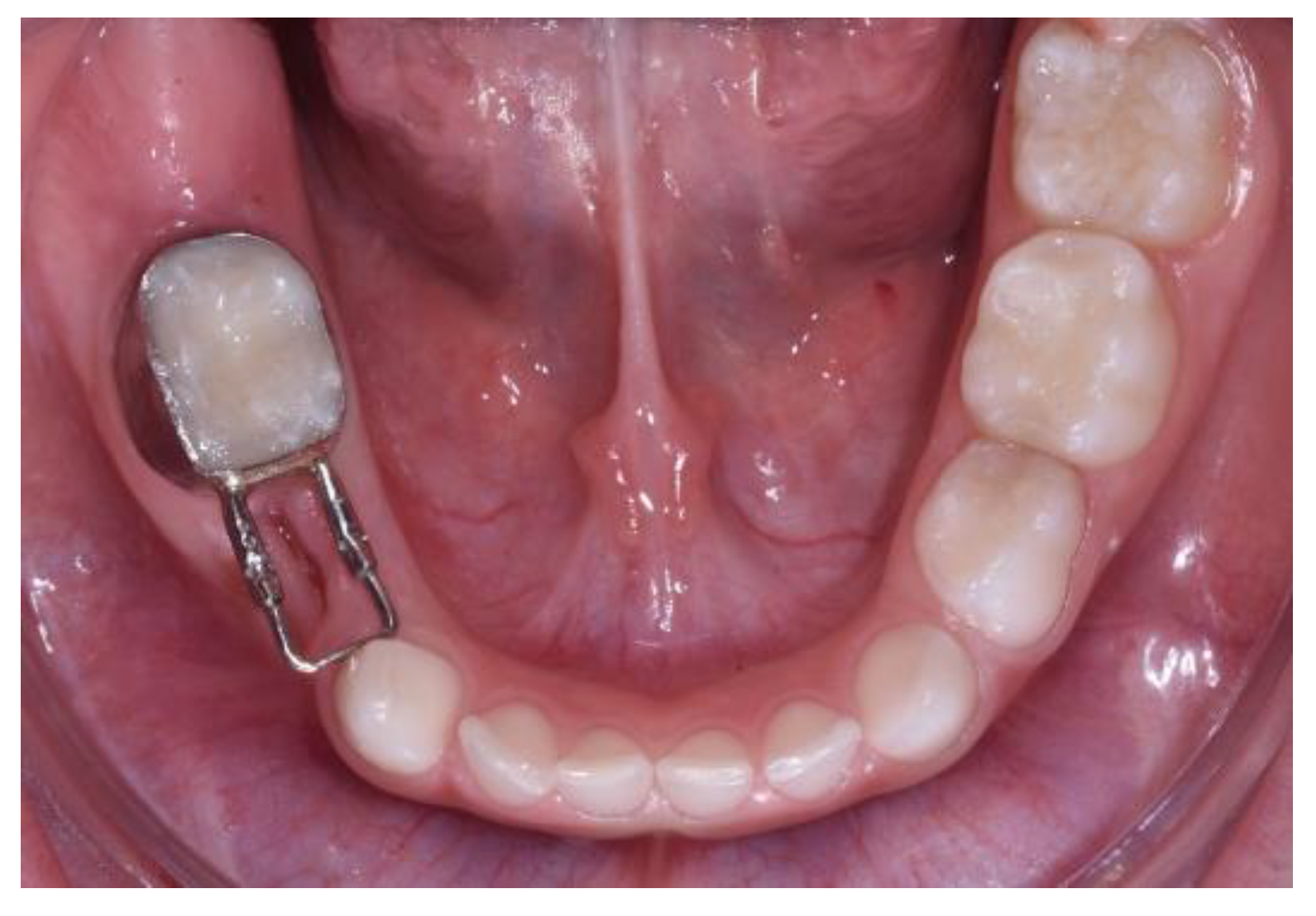 The benefits of space maintainers and clear braces in preventing